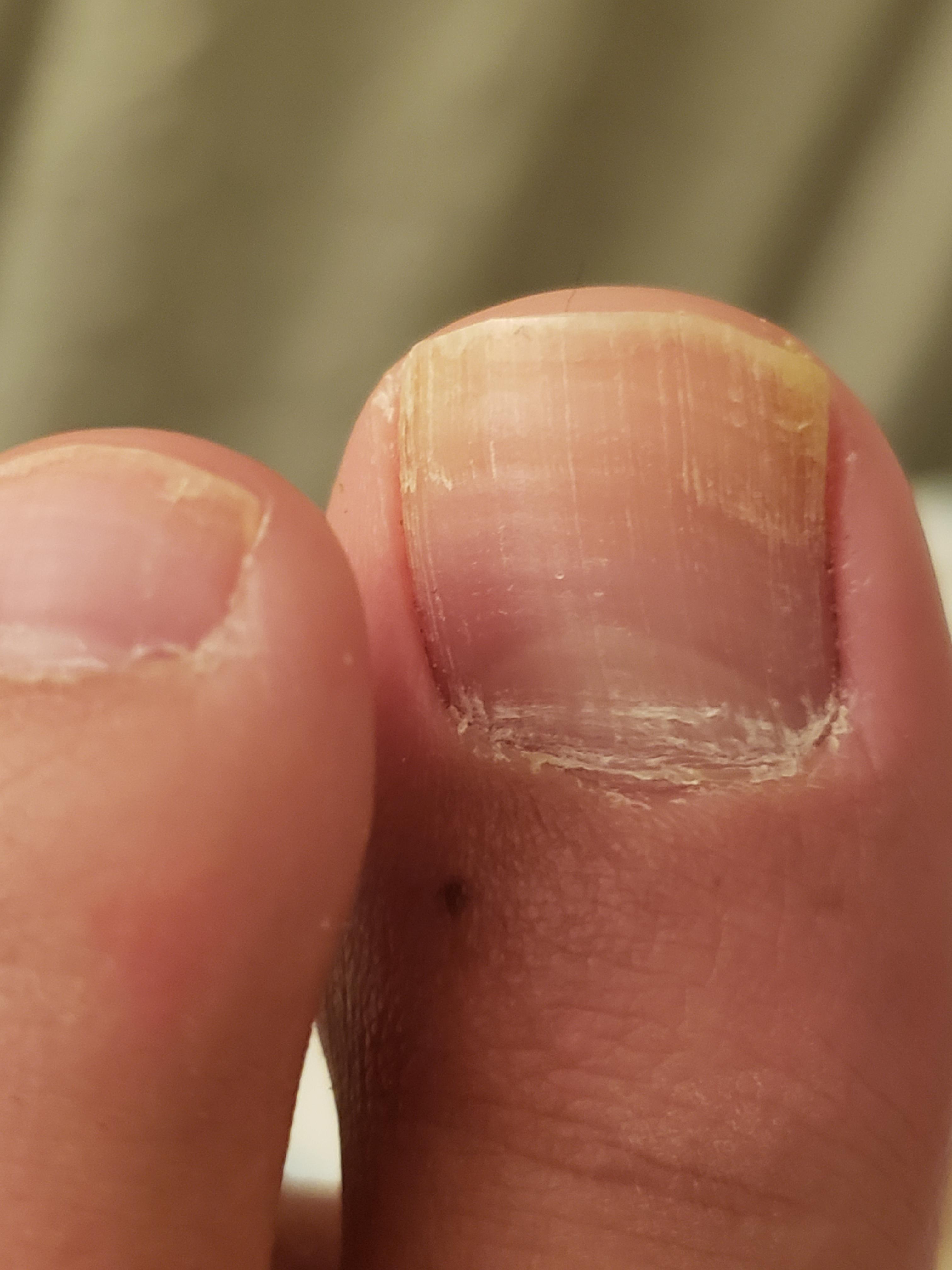 Been taking fluconazole for a few months for my right toe but noticed