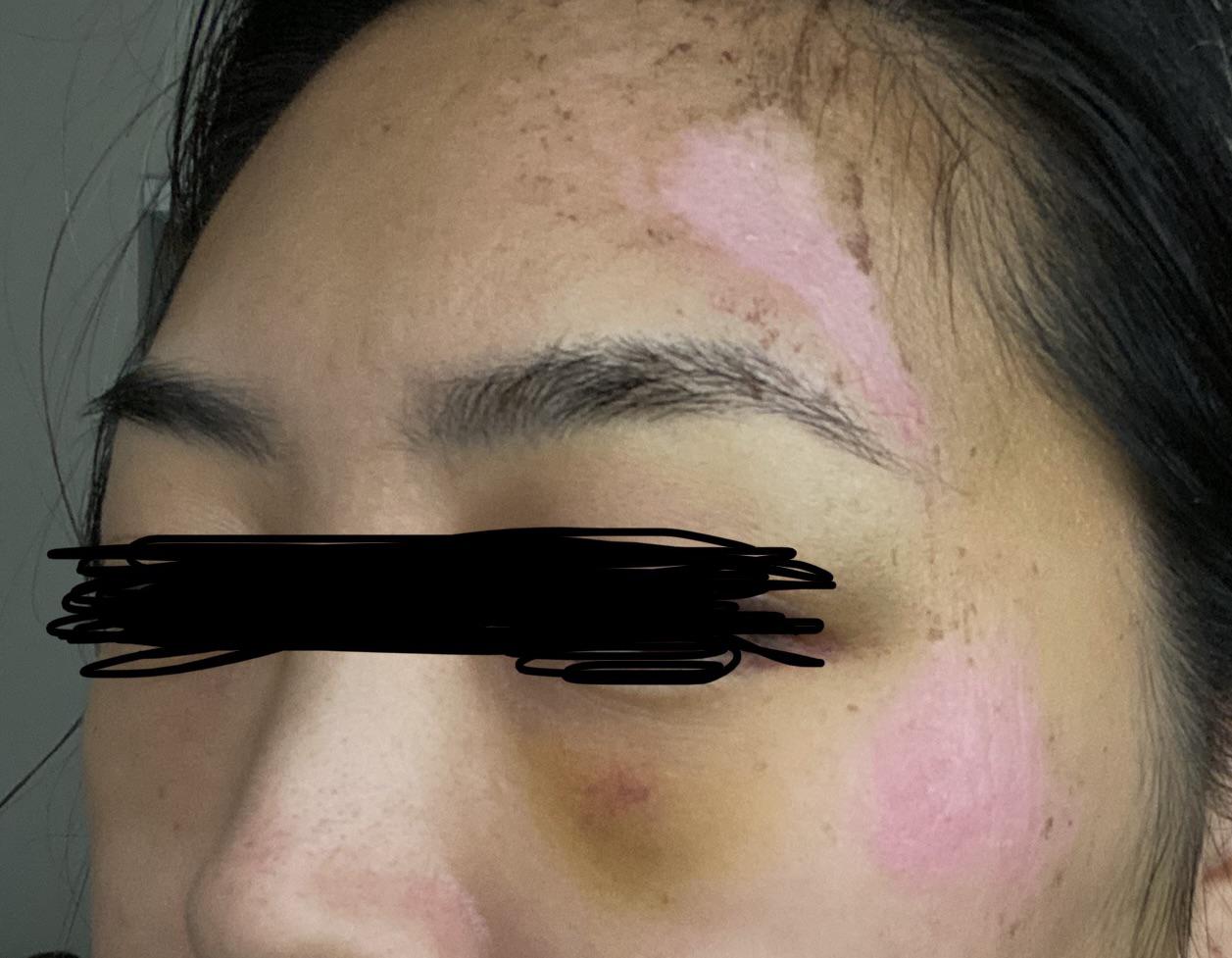 [Skin Concerns] Need help with scarring, road rash after getting hit by