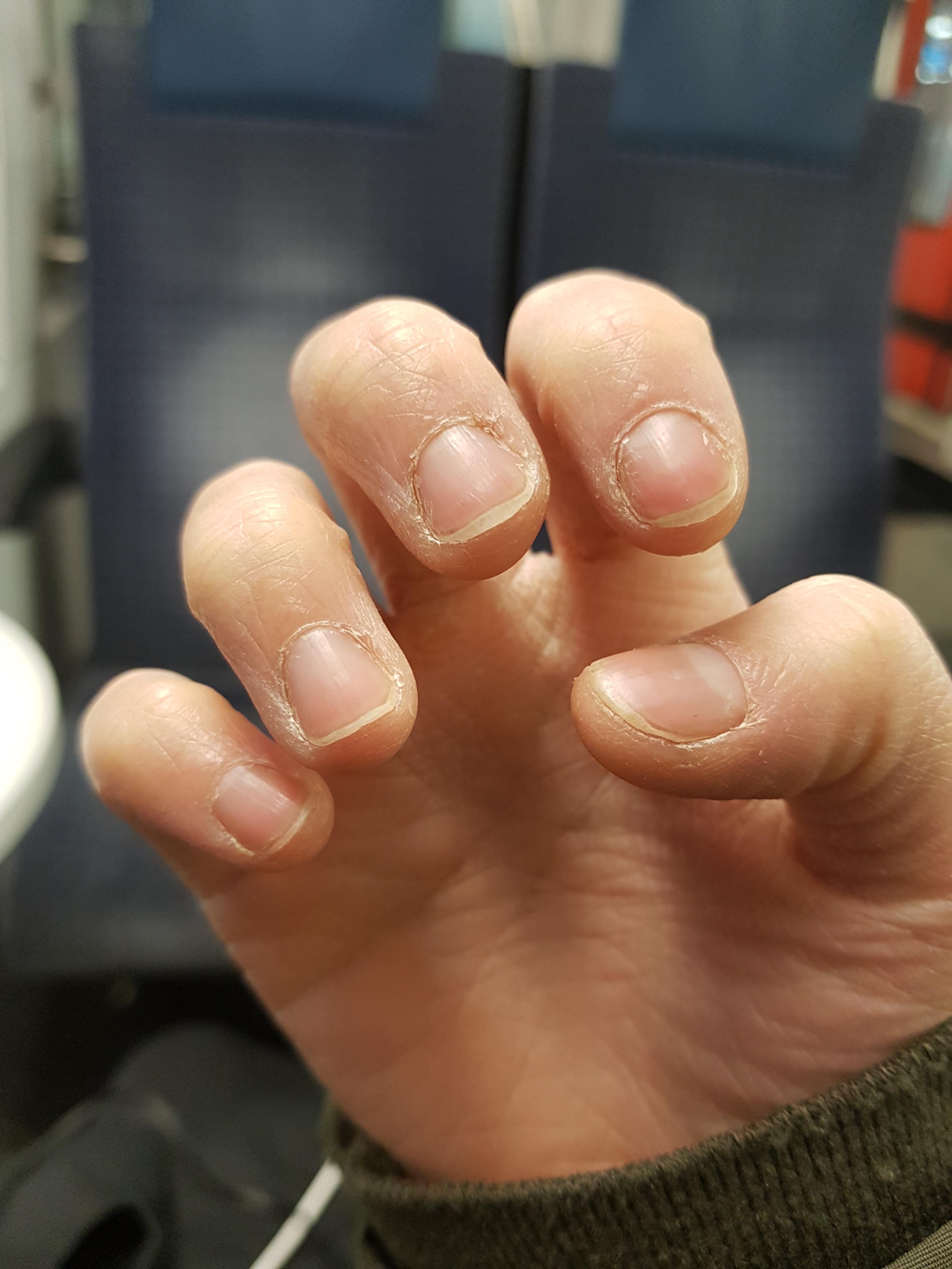 Two weeks ! Still eating the skin but I am leaving the nails D r