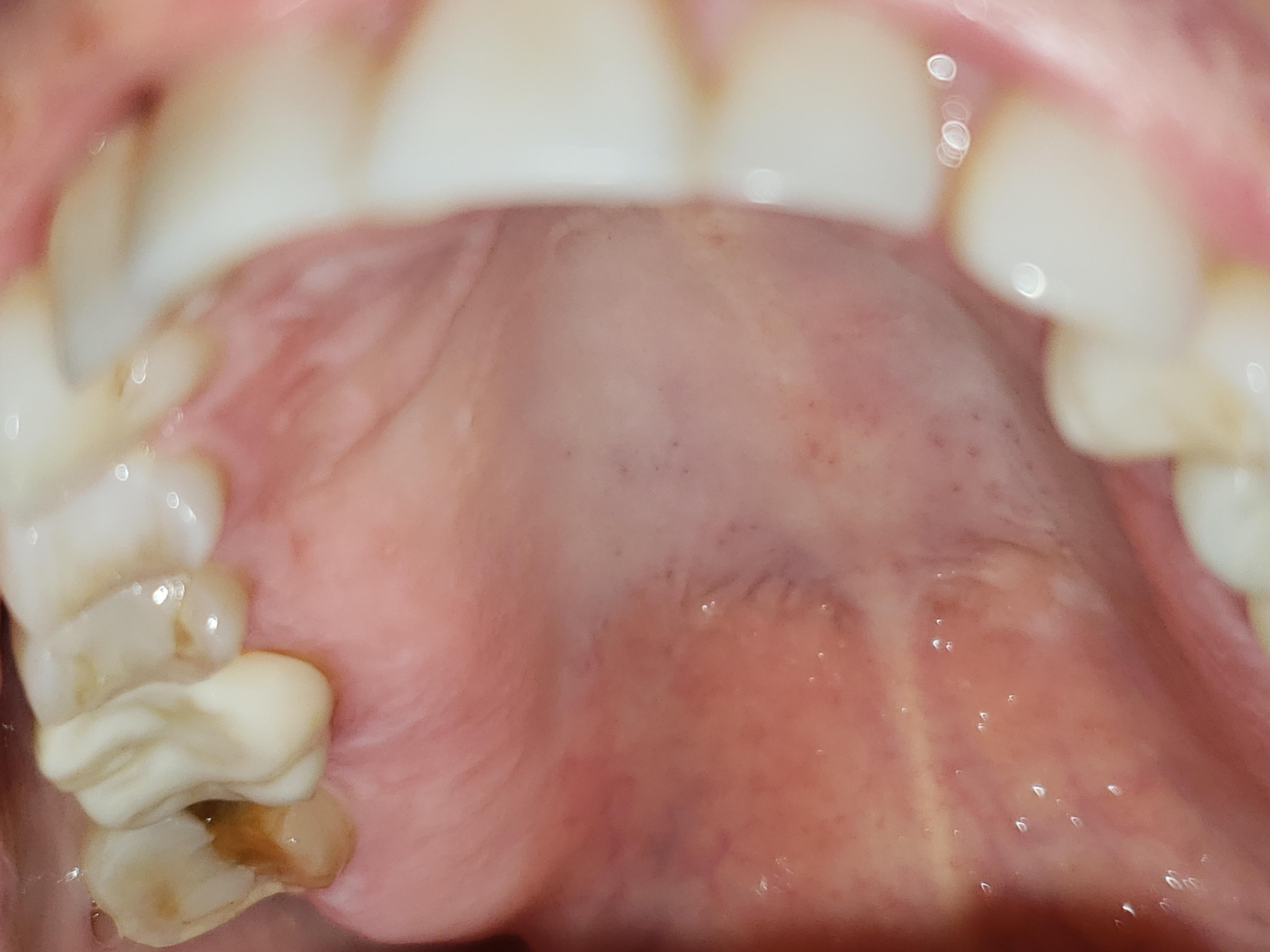 My mom is visiting and half her tooth just cracked out of her mouth