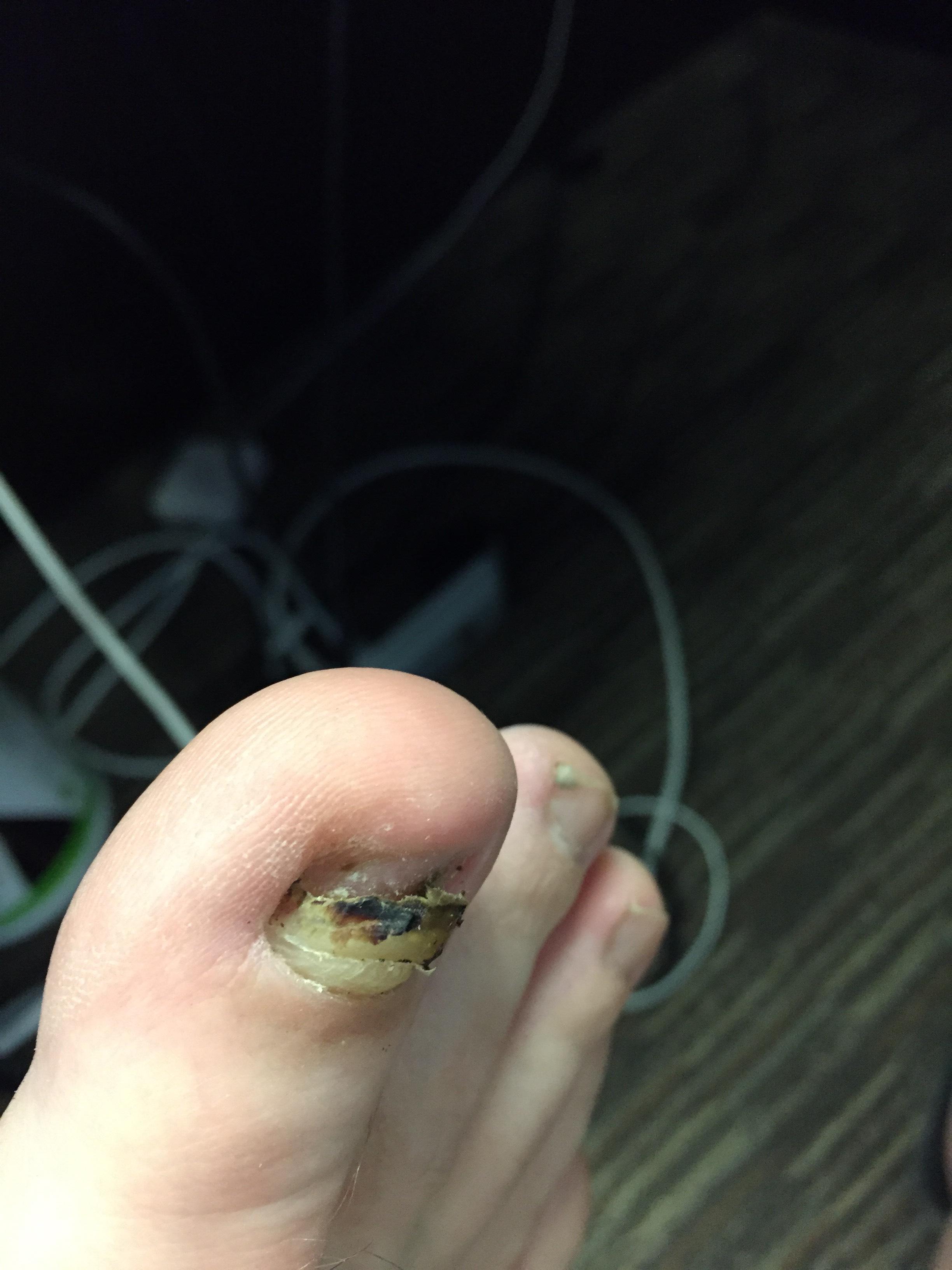 My Toenail Came Off Today! r/mildlyinteresting