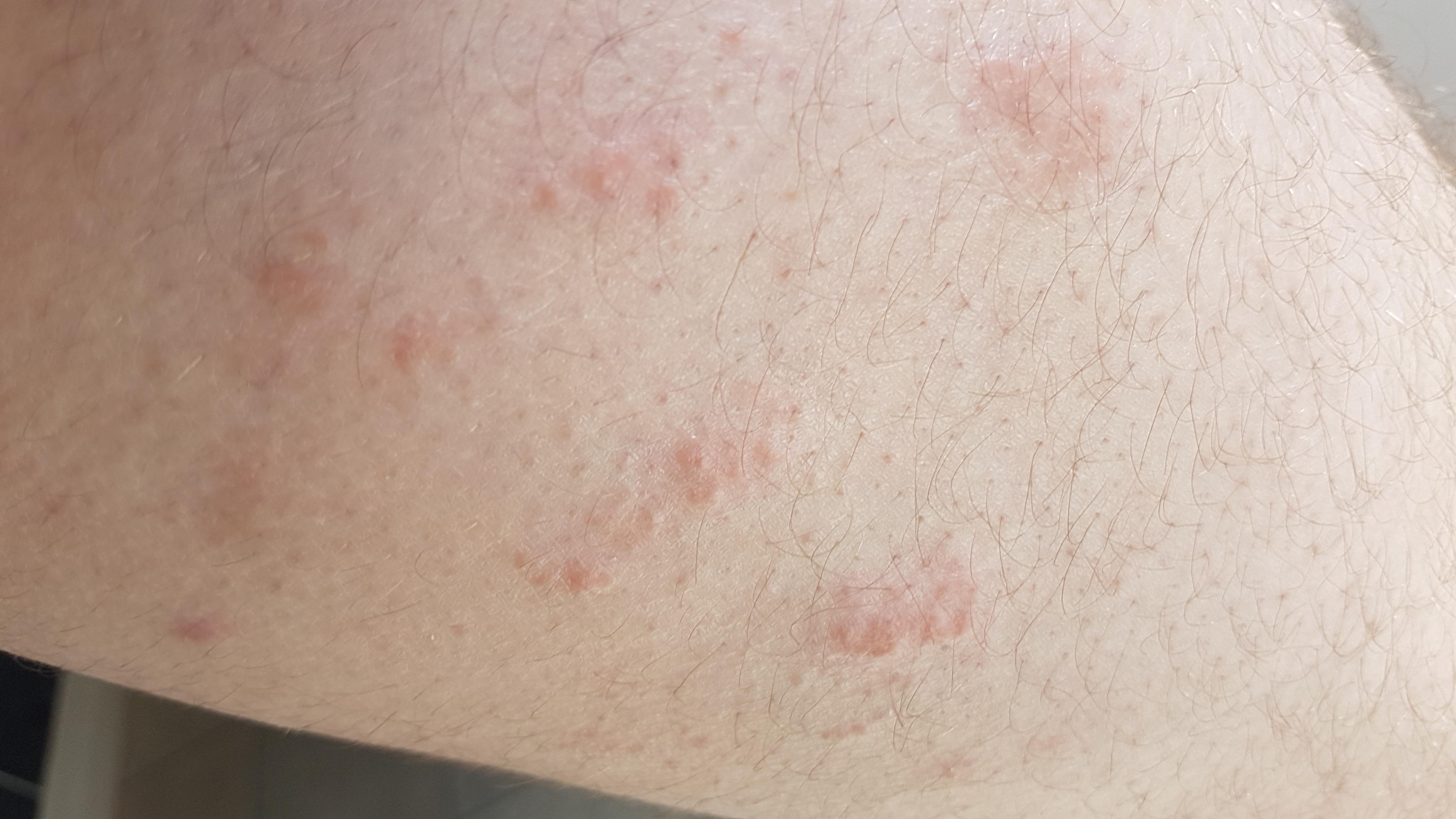 Had this rash over both upper legs at a place I lived a couple of years