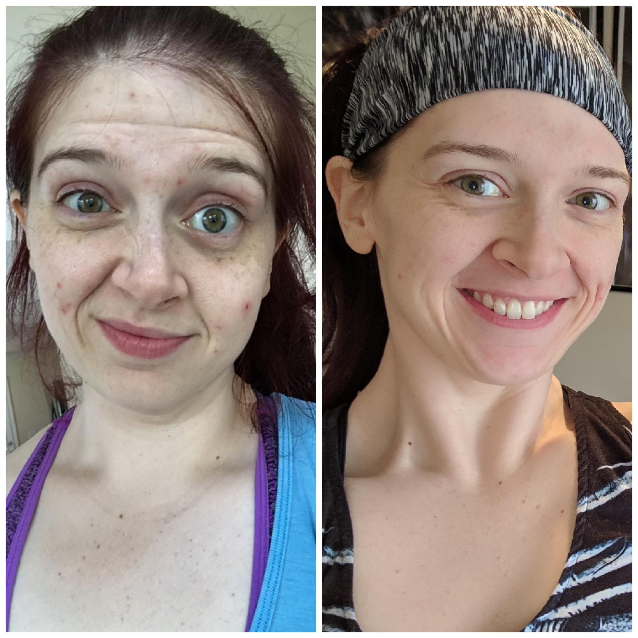 Top 100+ Pictures Does Lack Of Water Cause Acne Excellent