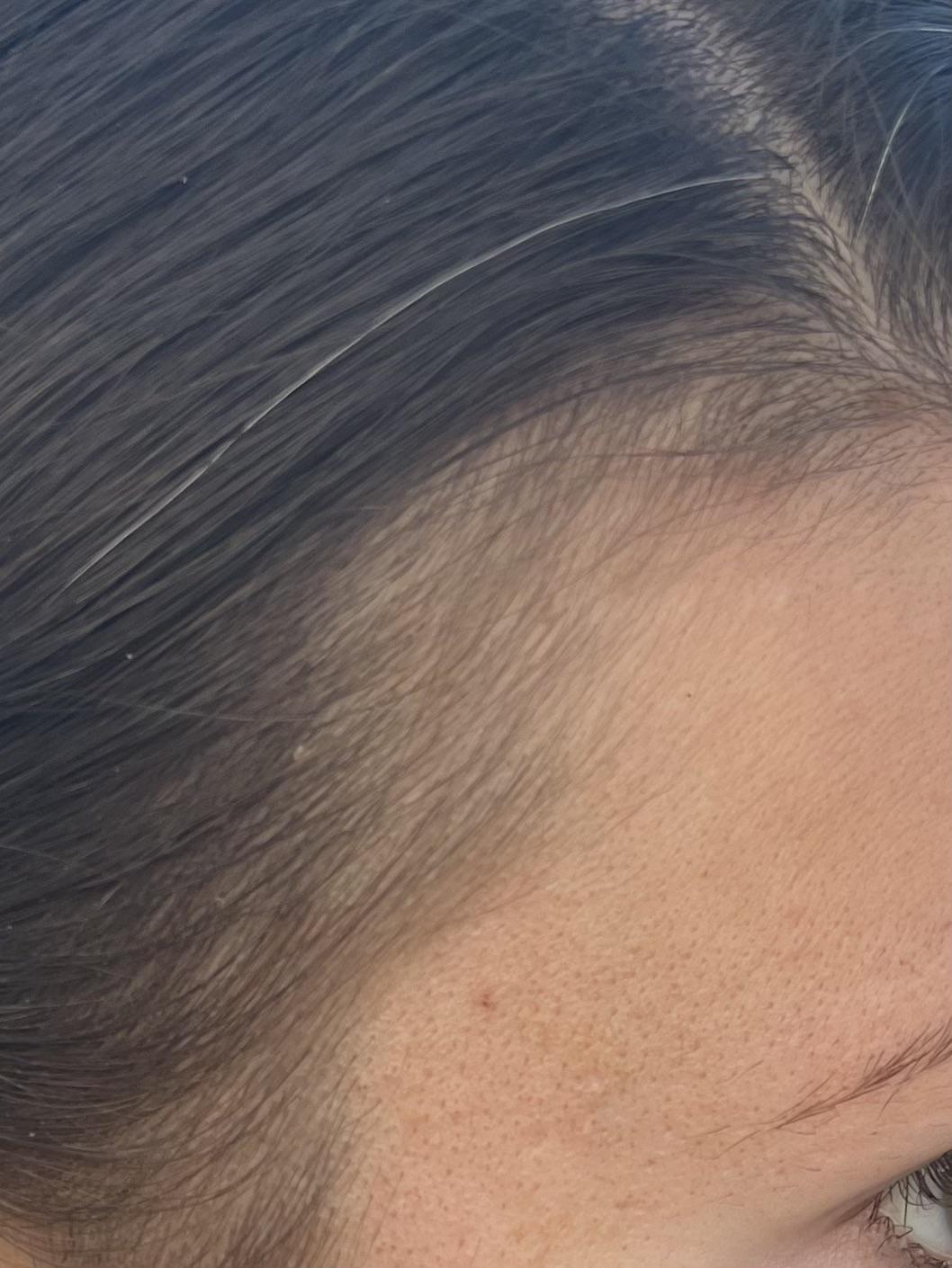 Will these vellus hairs eventually be terminal? r/TelogenEffluvium