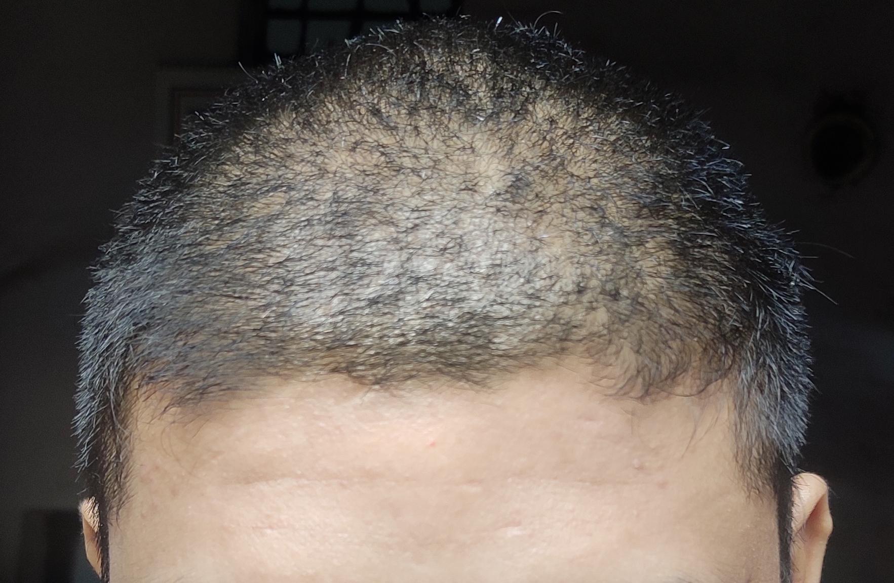 After constant itching on the scalp, getting red bumps on the forehead