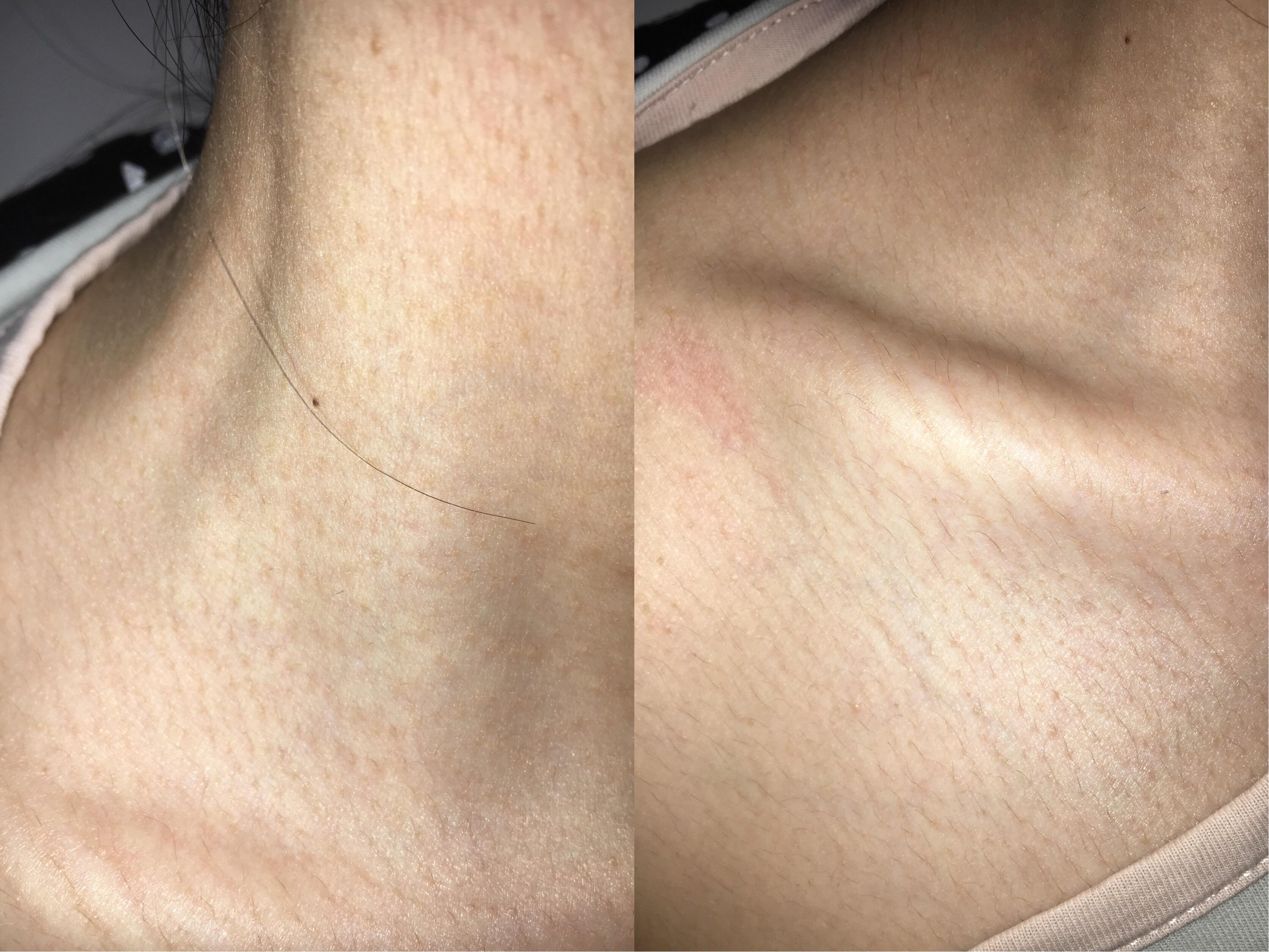[Skin Concern] Why is the texture on my upper chest/neck