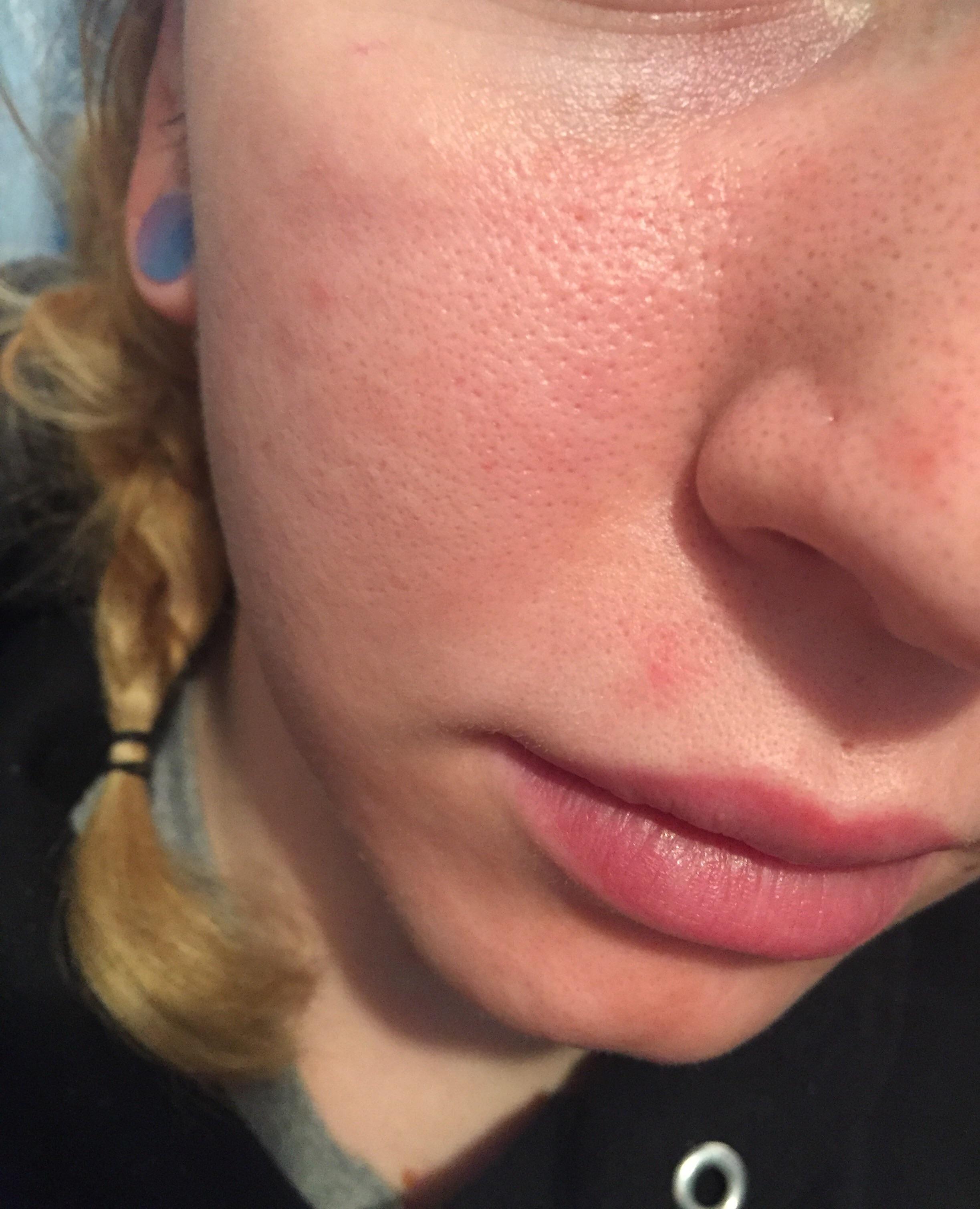[Skin Concerns] A few different things going on in this picture, does