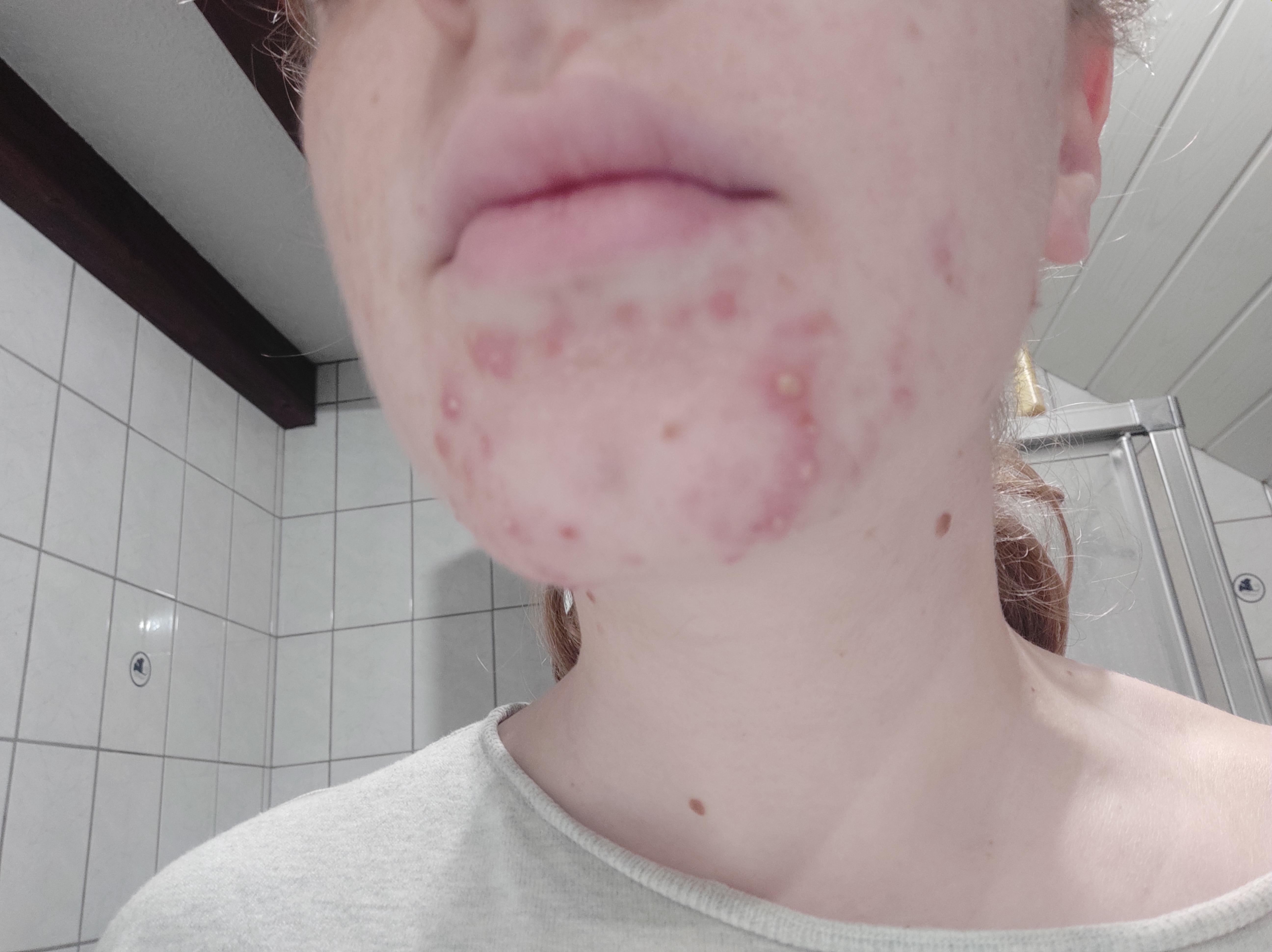 Started Zinc 15 days ago, my acne got worse, should I stop? r/acne