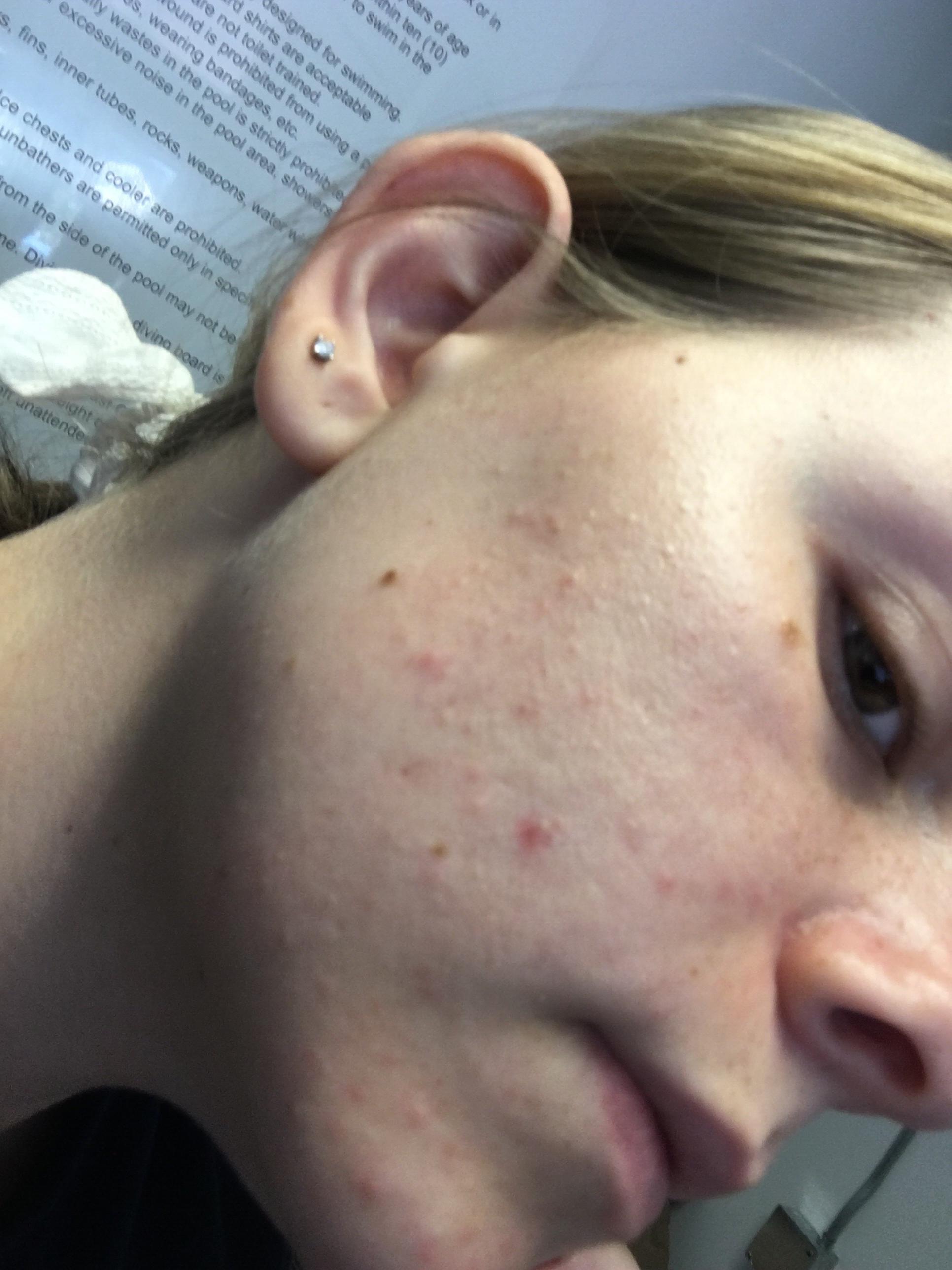 [skin concerns] I’ve been dealing with texture on both sides of my face
