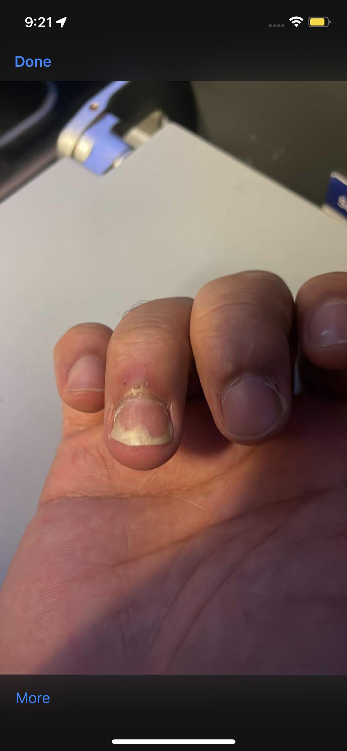 Image of my nail I posted earlier about using terbinafine and