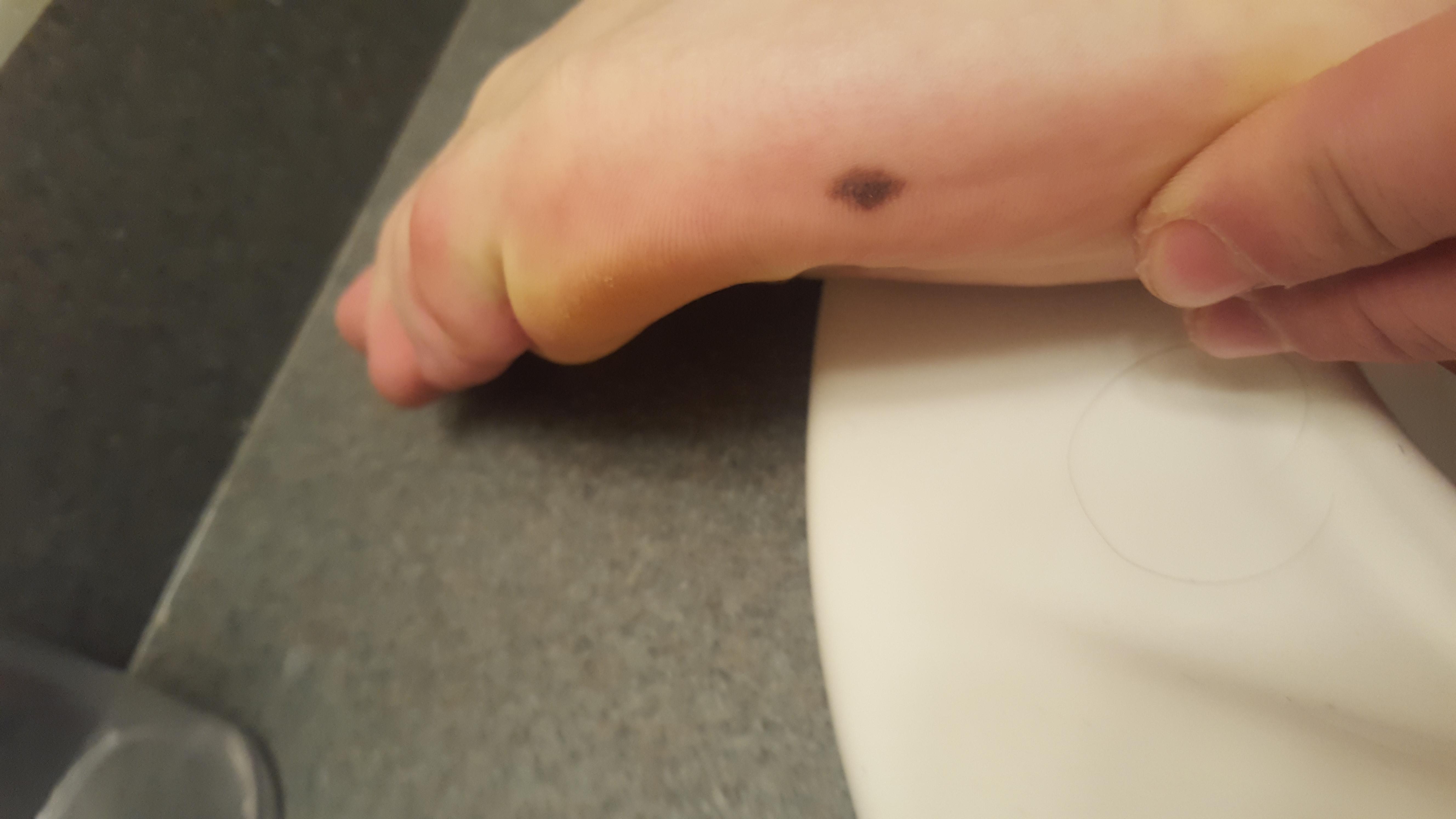 Is this a normal mole? The picture shows the side of my foot. r/Melanoma