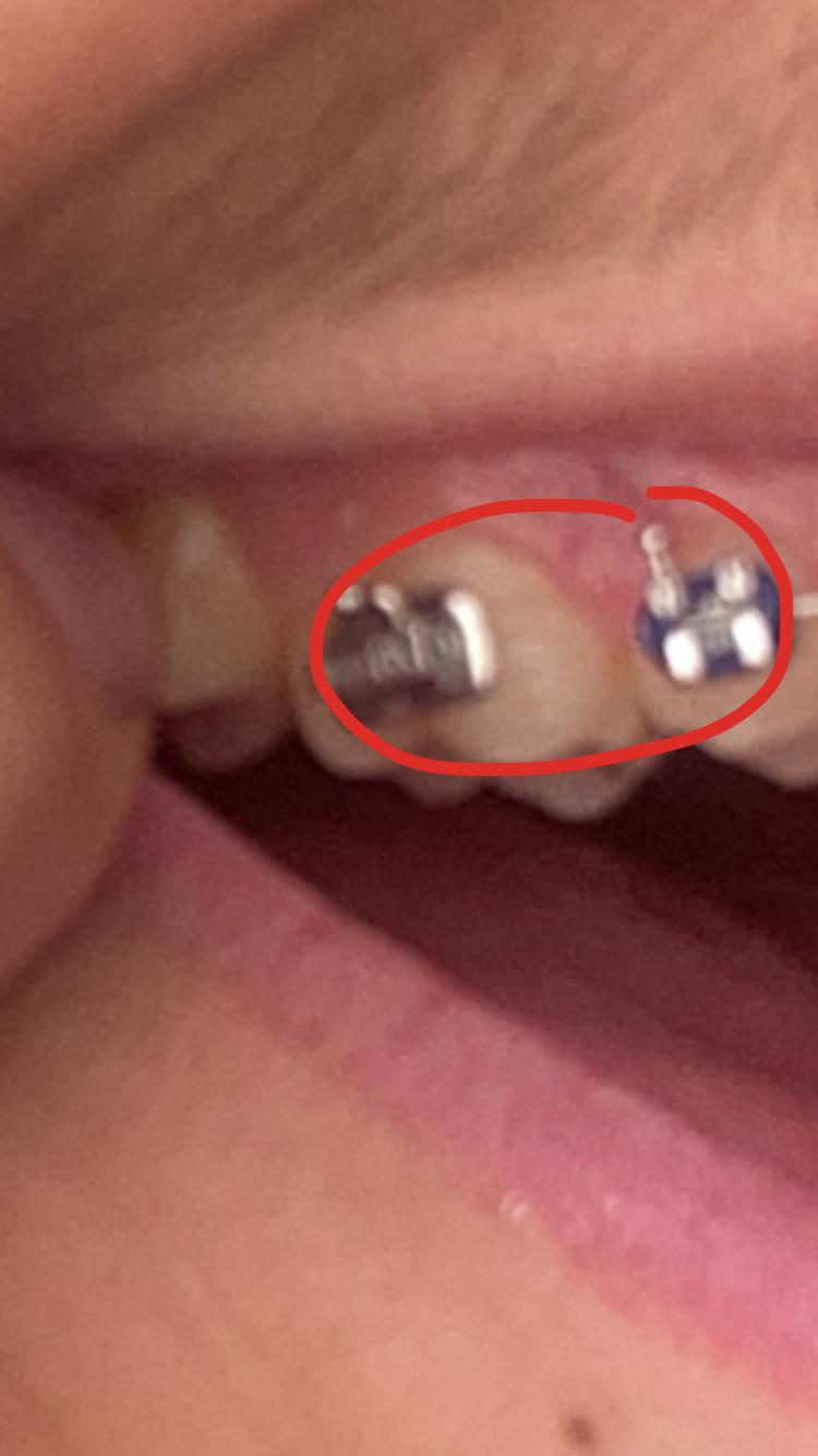 why didnt my ortho connect the wire all the way to the last bracket