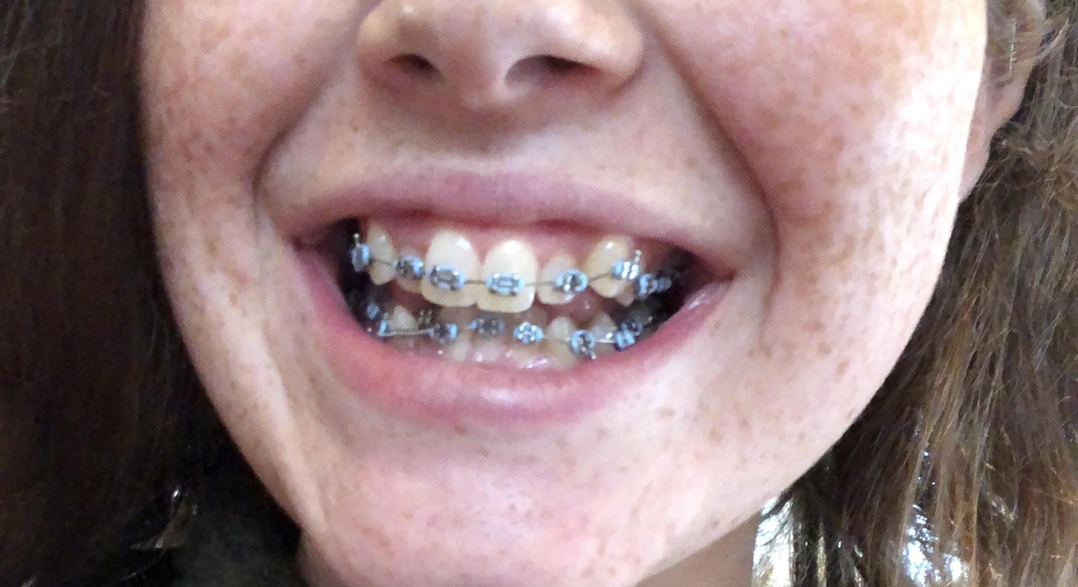 Picture of my braces day one for the people who were asking ) r/braces