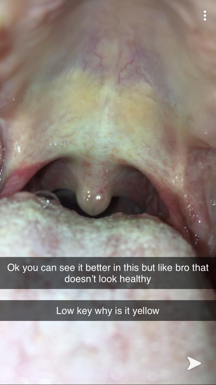 Worried about the look of roof of mouth and my hangy thingy pls advice