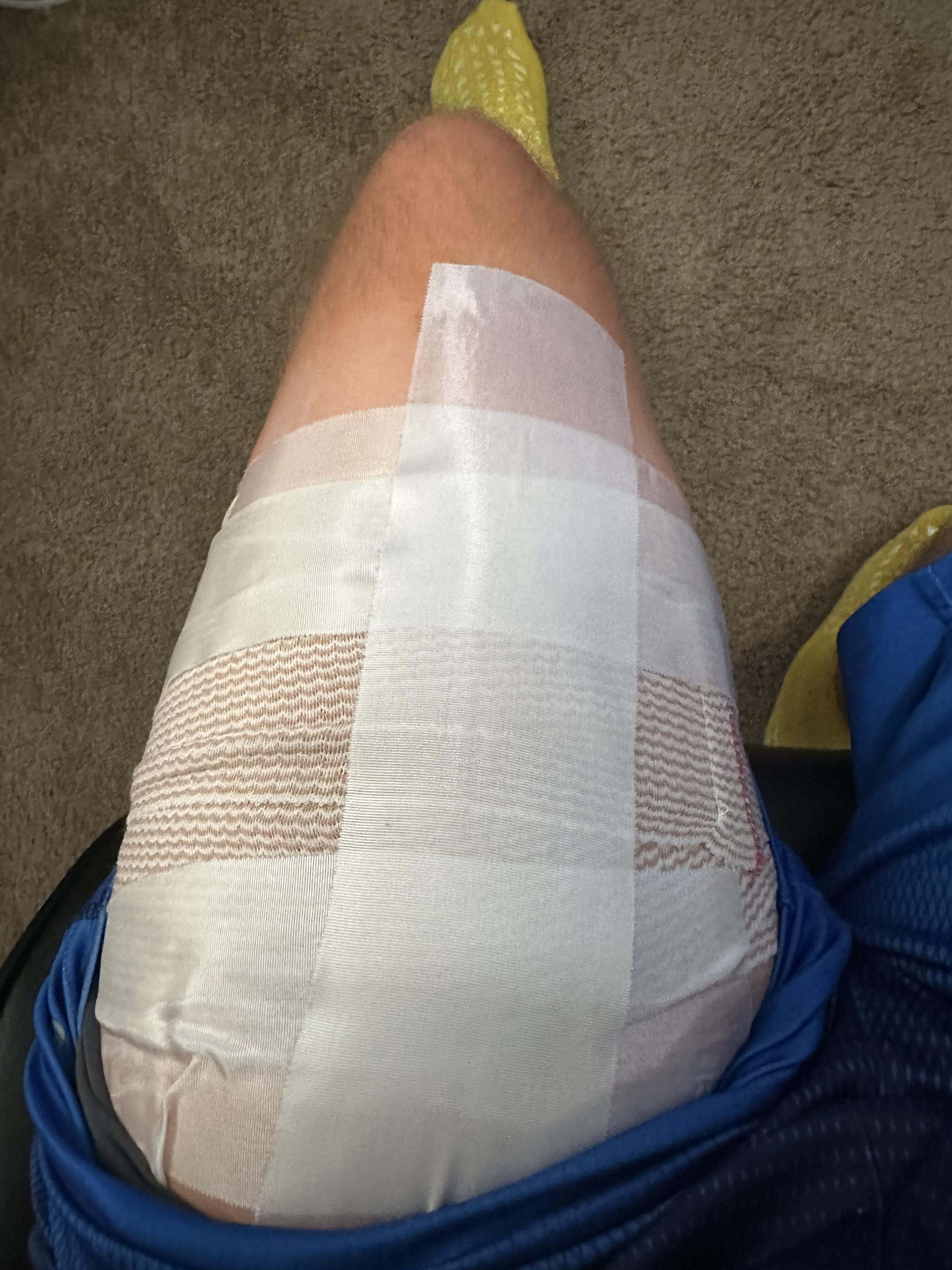 How long does muscle biopsy take to heal? r/mito