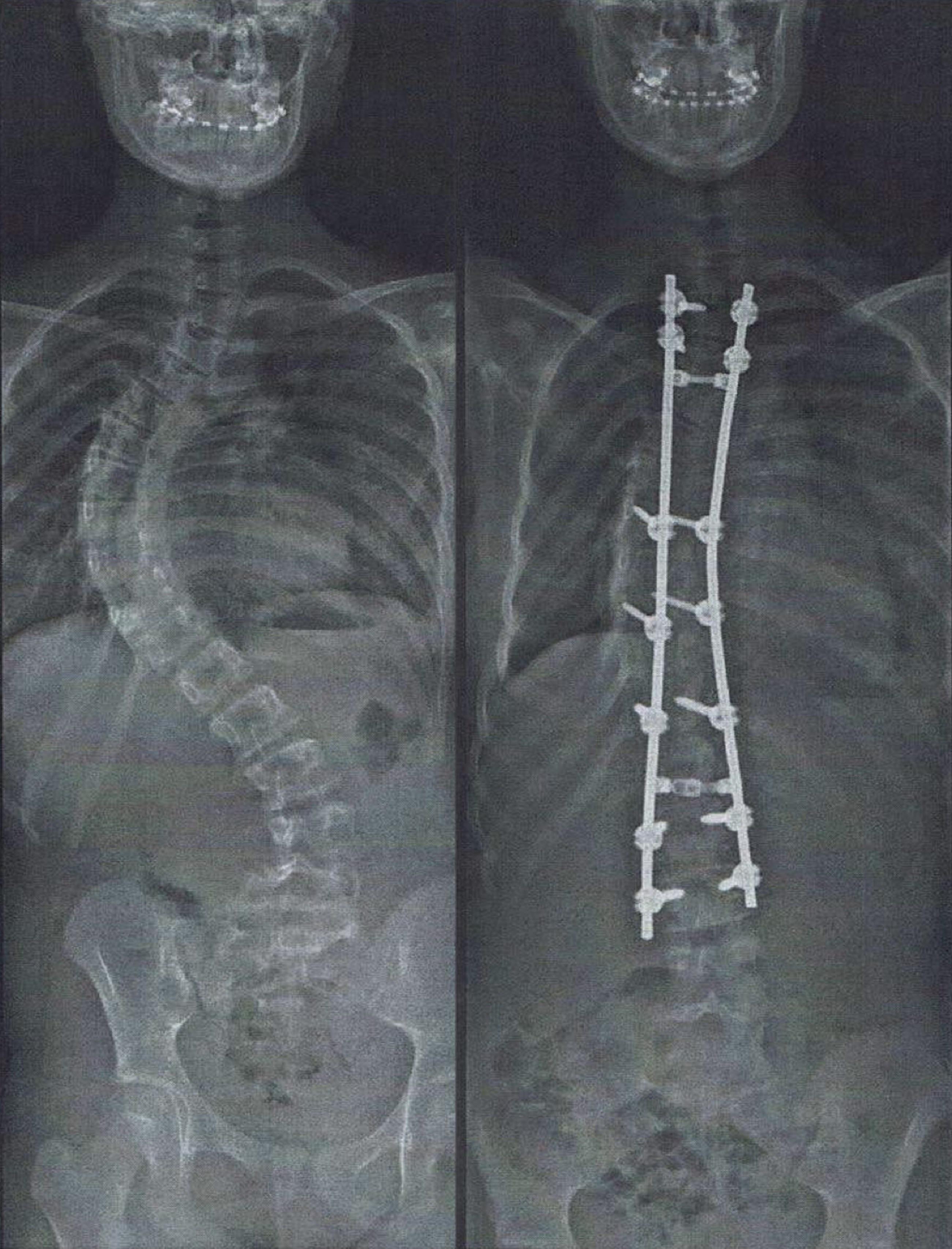 Will I gain height after scoliosis treatment? scoliosis