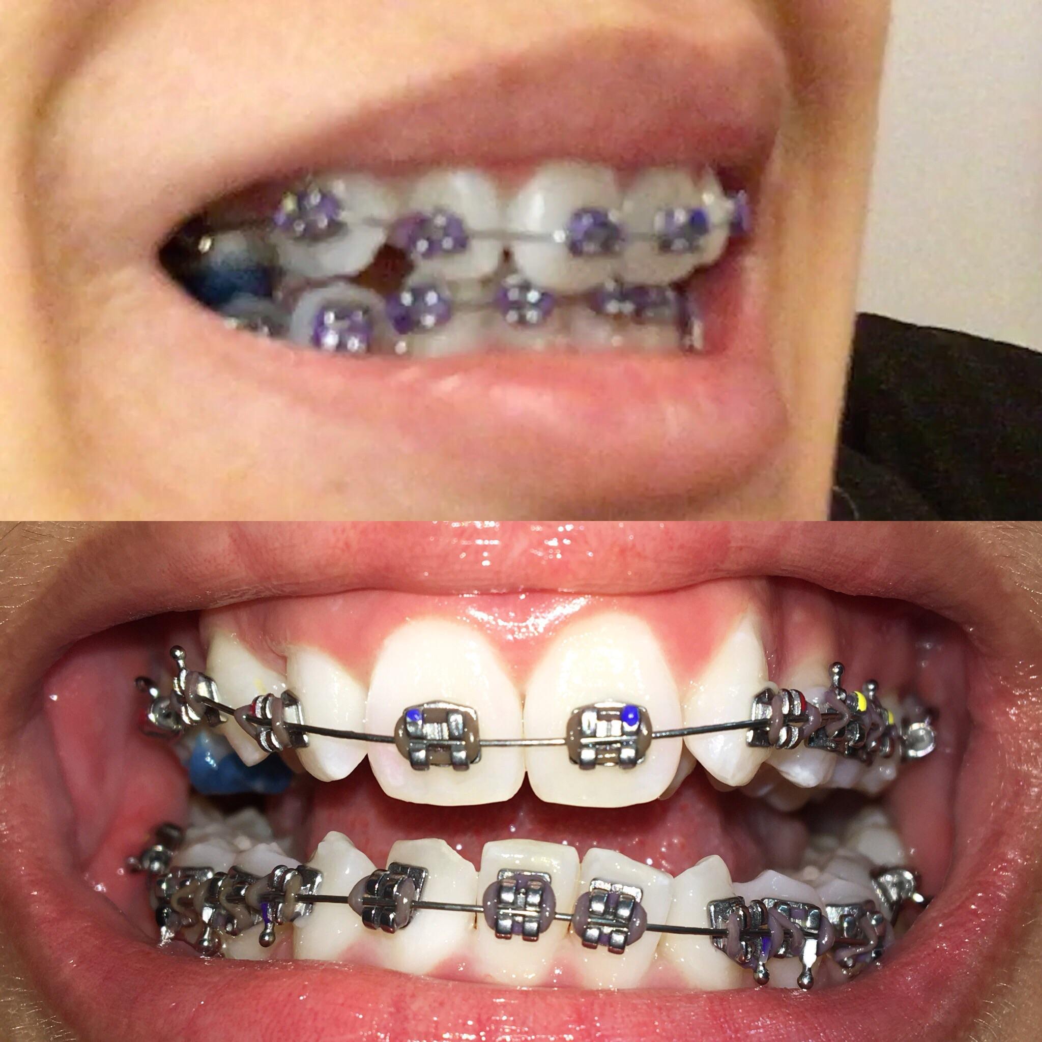 I used to have super pretty purple ligatures and literally three days