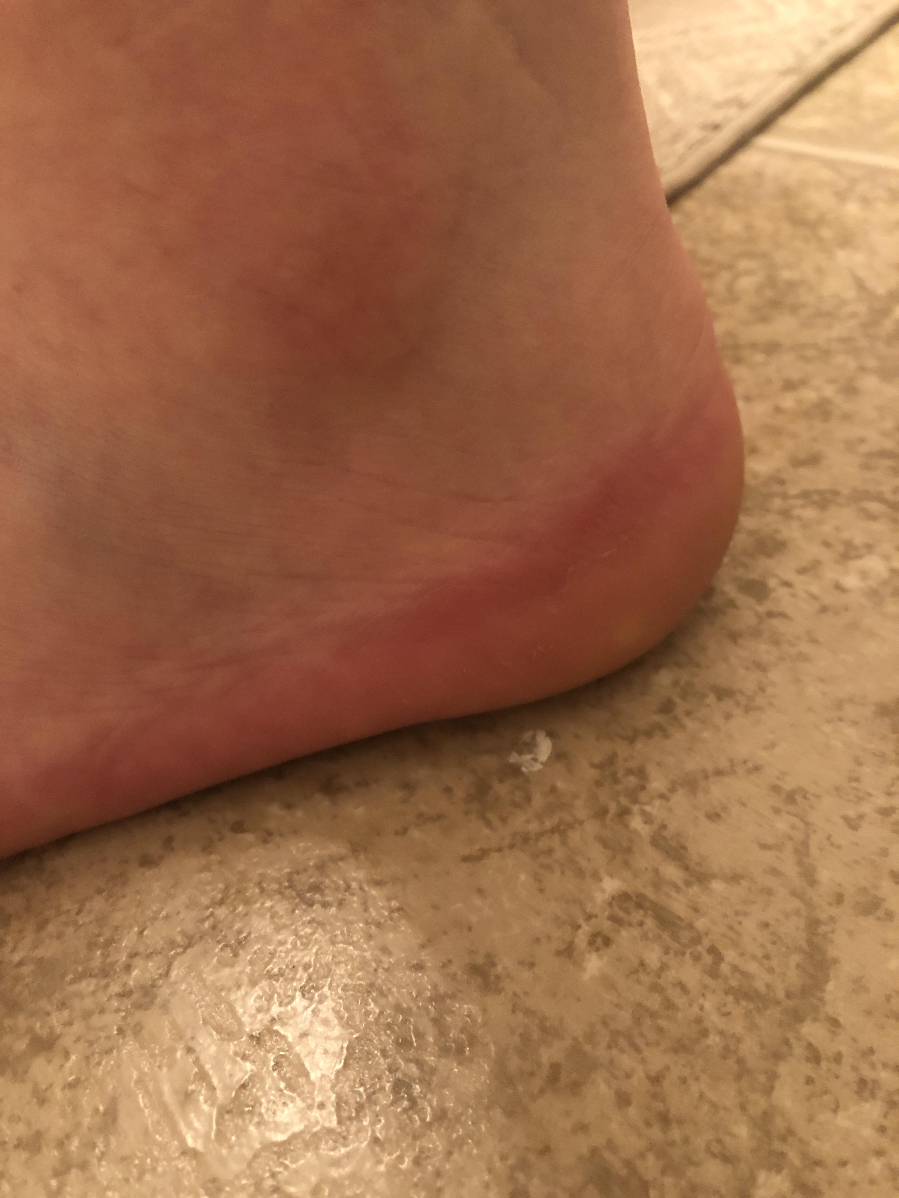 Is this common for PF; Redness in the heel? I’m scared it might be