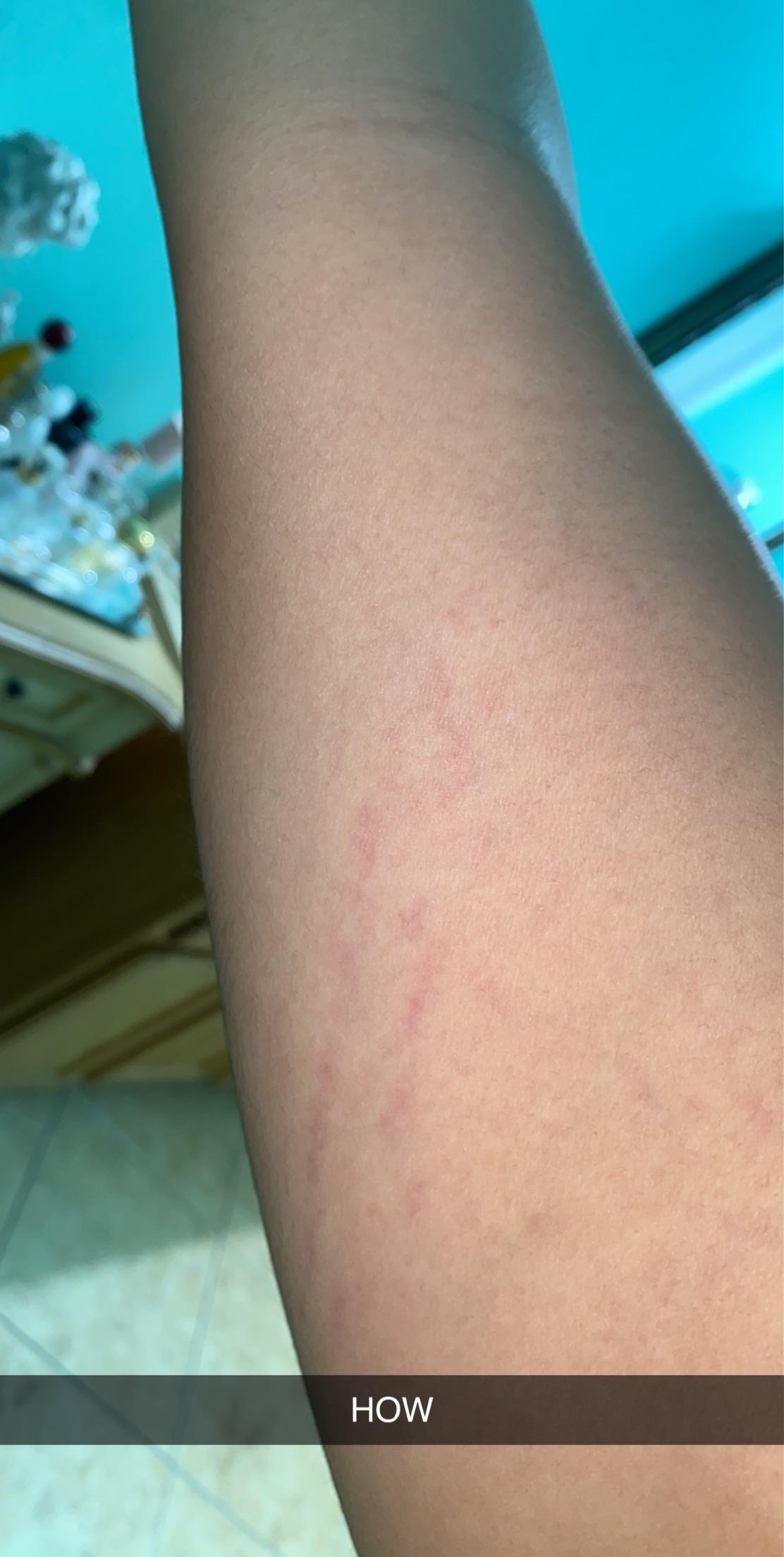 Are these stretch marks on the upper inner side of my arm? There was