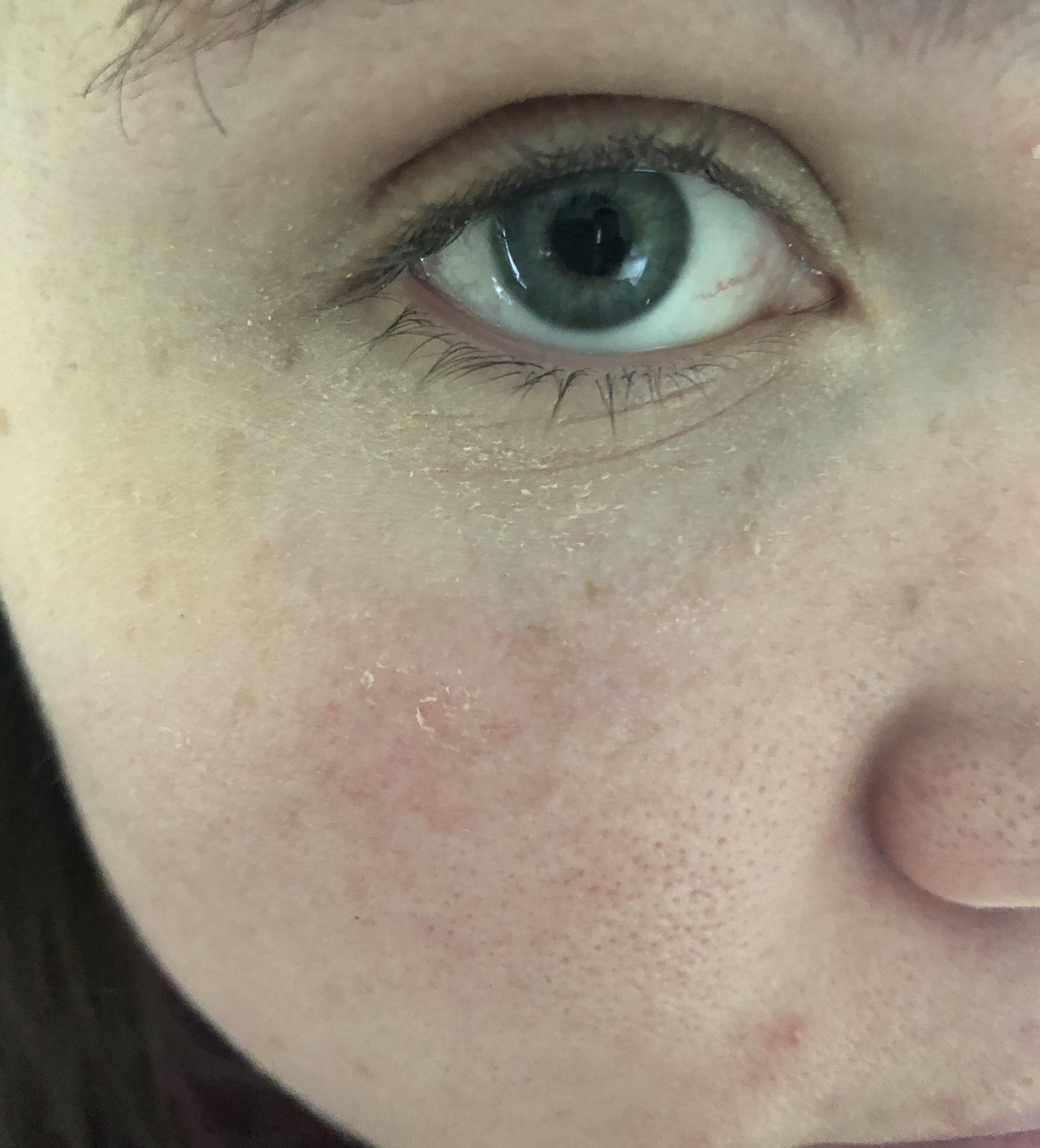 [routine help] under eye concealer reveals super dry skin under eyes