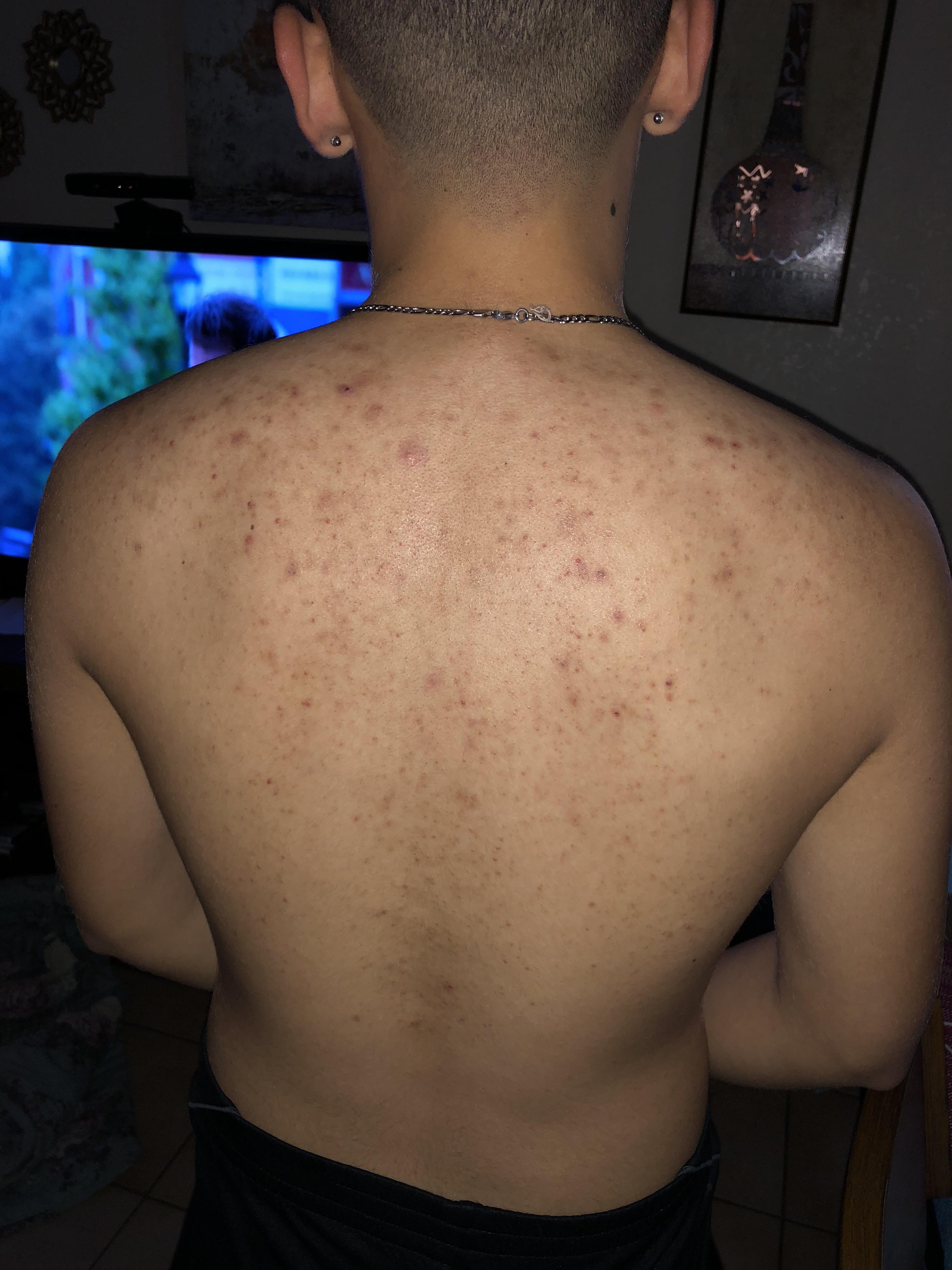 How to get rid of back acne? r/acne