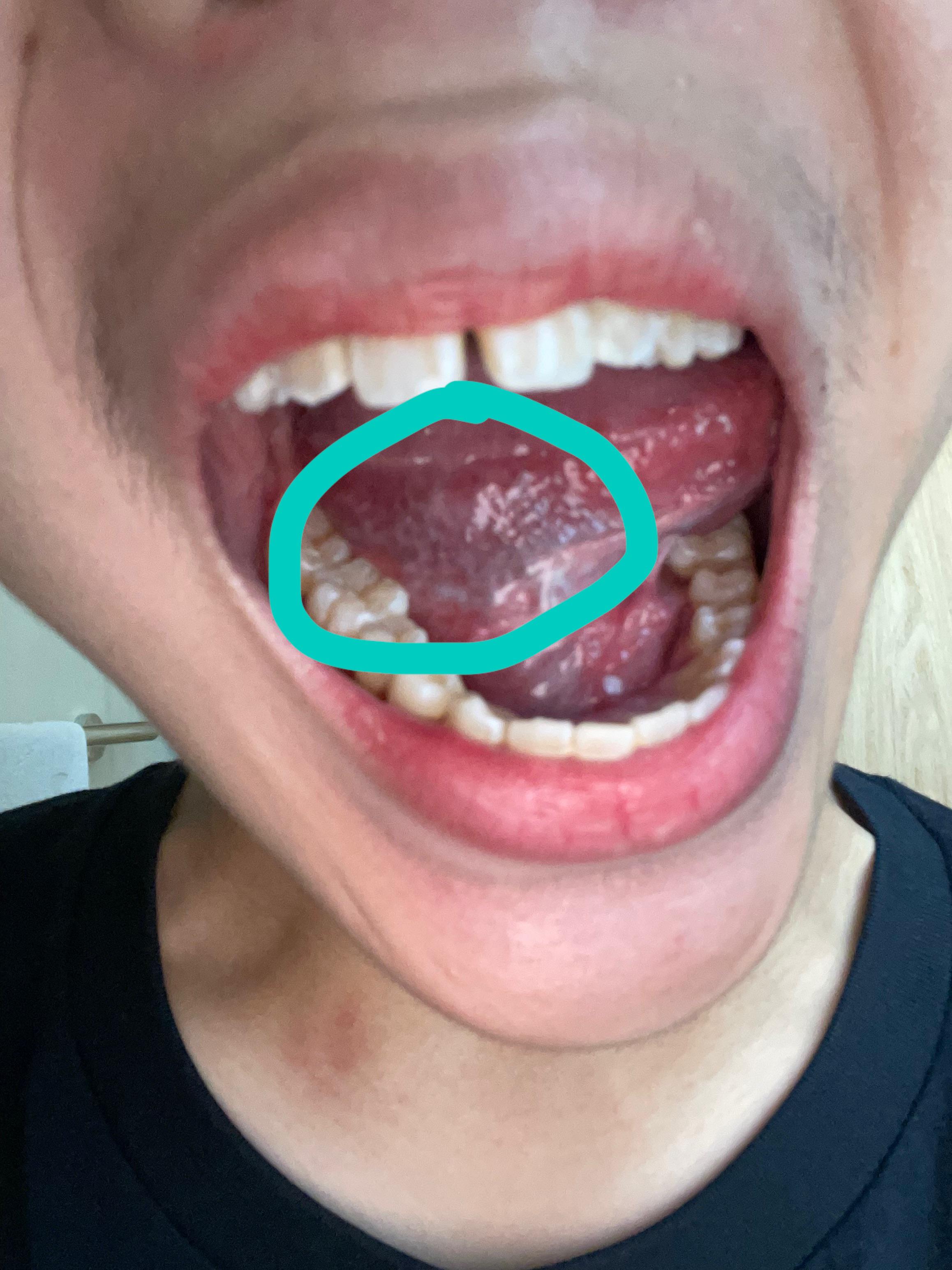 is this tongue cancer? r/medical