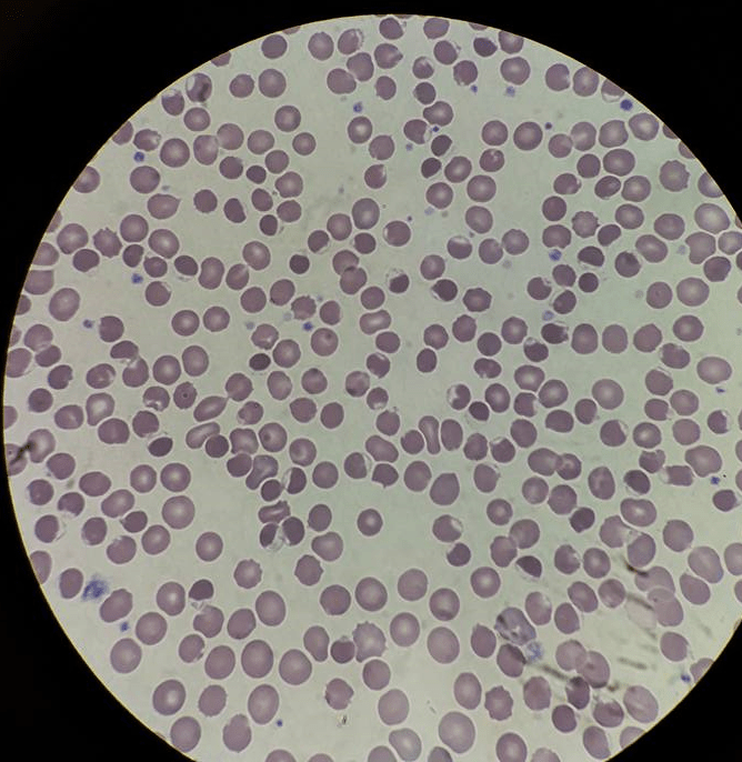 Peripheral Blood Smear G6pd Deficiency Patient Stock Photo, 45 OFF