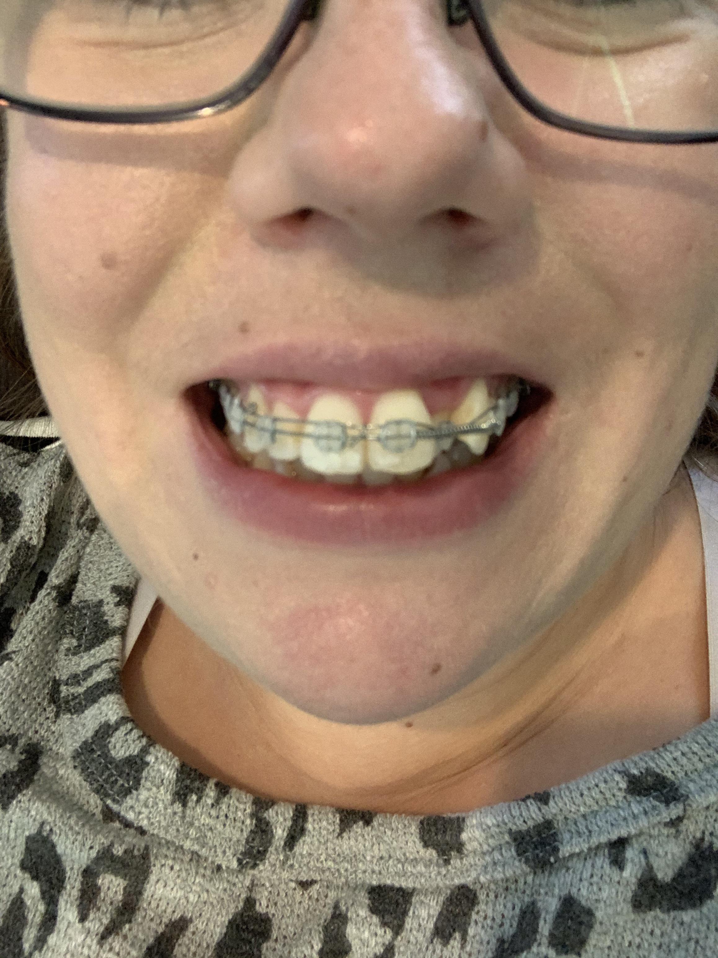 Has anyone ever had a double wire? What is the purpose? Just curious! I