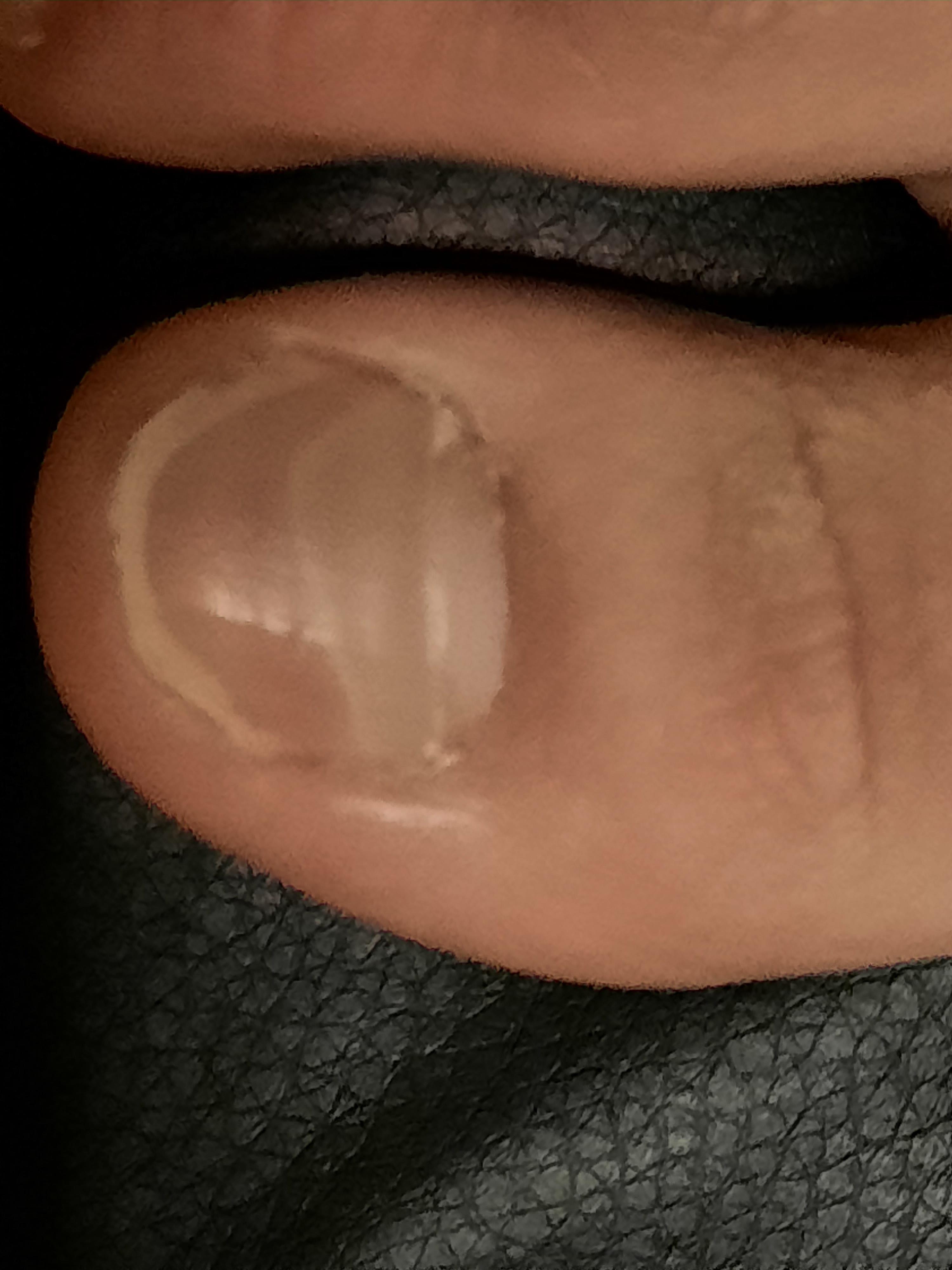 My toe nail is half white? I don't have other symptoms other than mild
