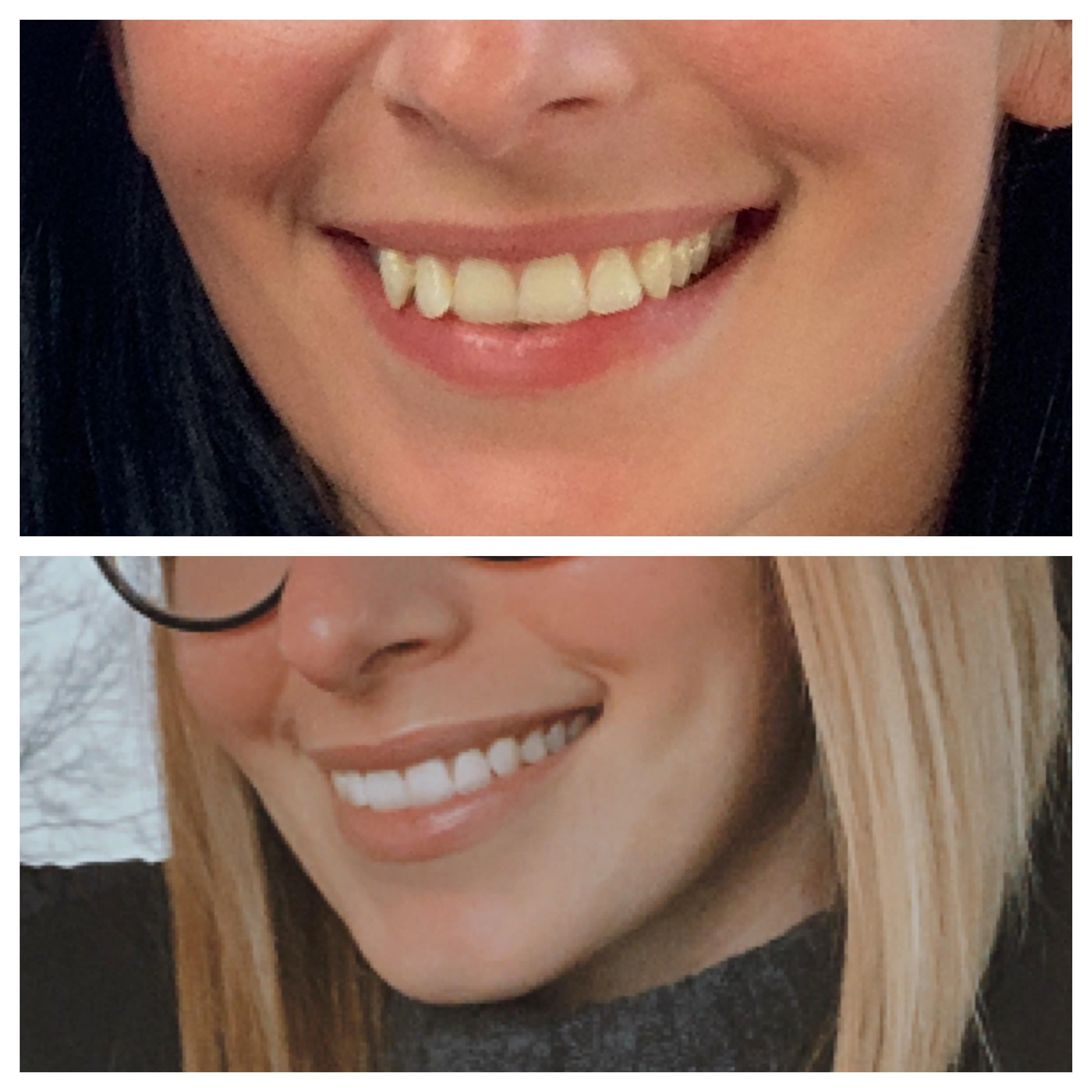 After 20 trays, 4 refinements, and now 6 months of religiously wearing