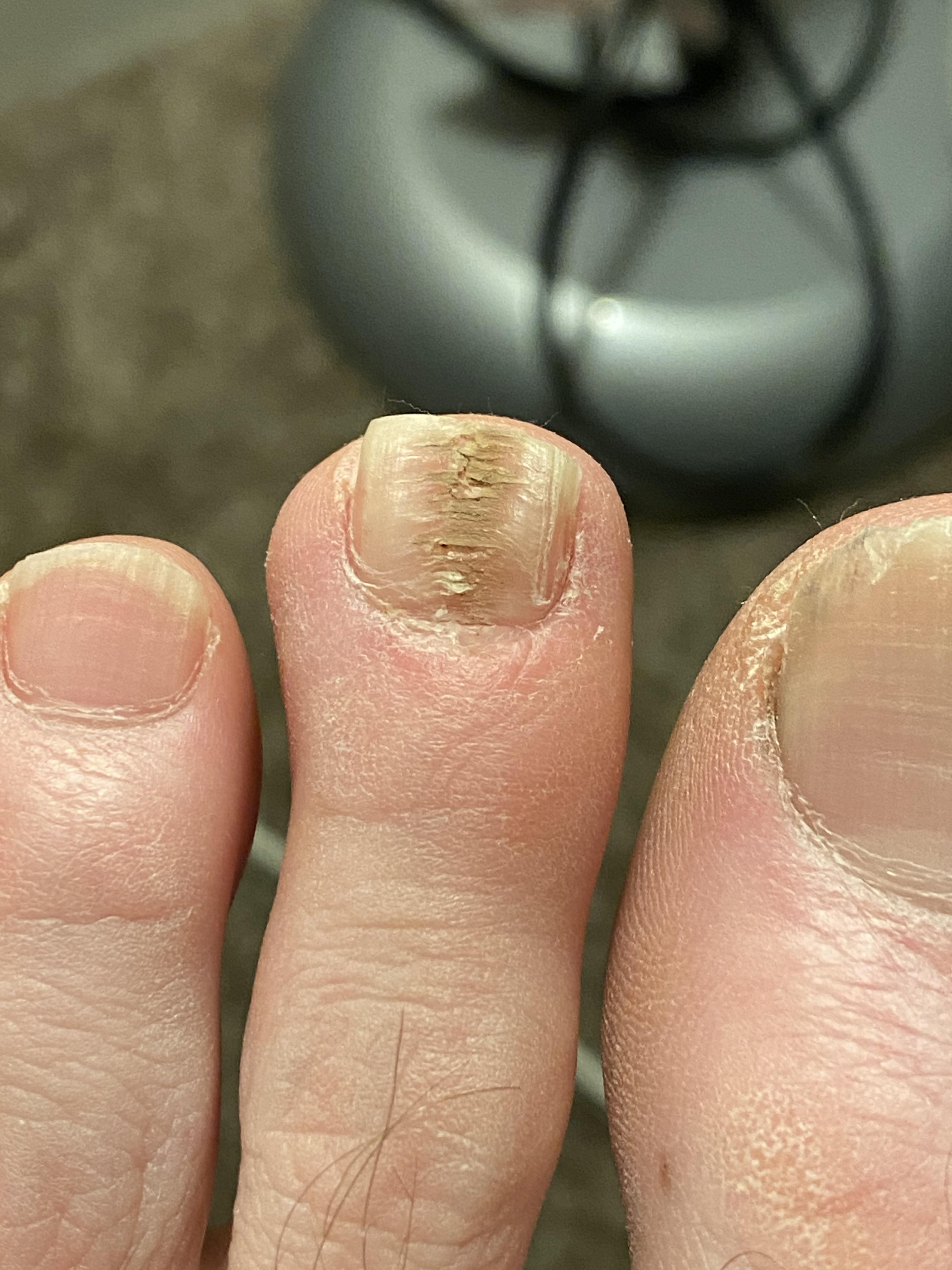 Is this a Nail fungus? I lost the white part on top of the nail cuticle