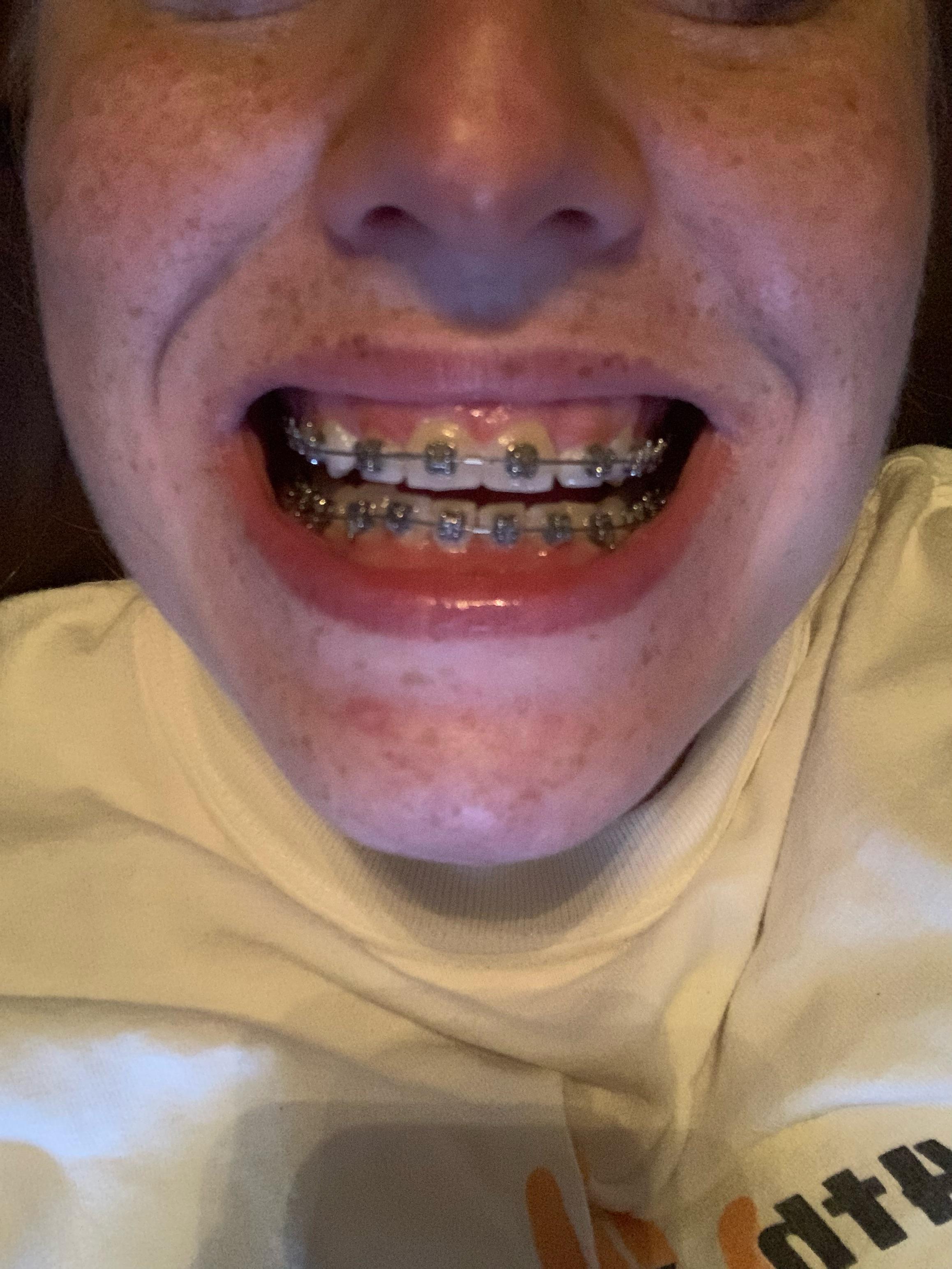 6 months in! r/braces
