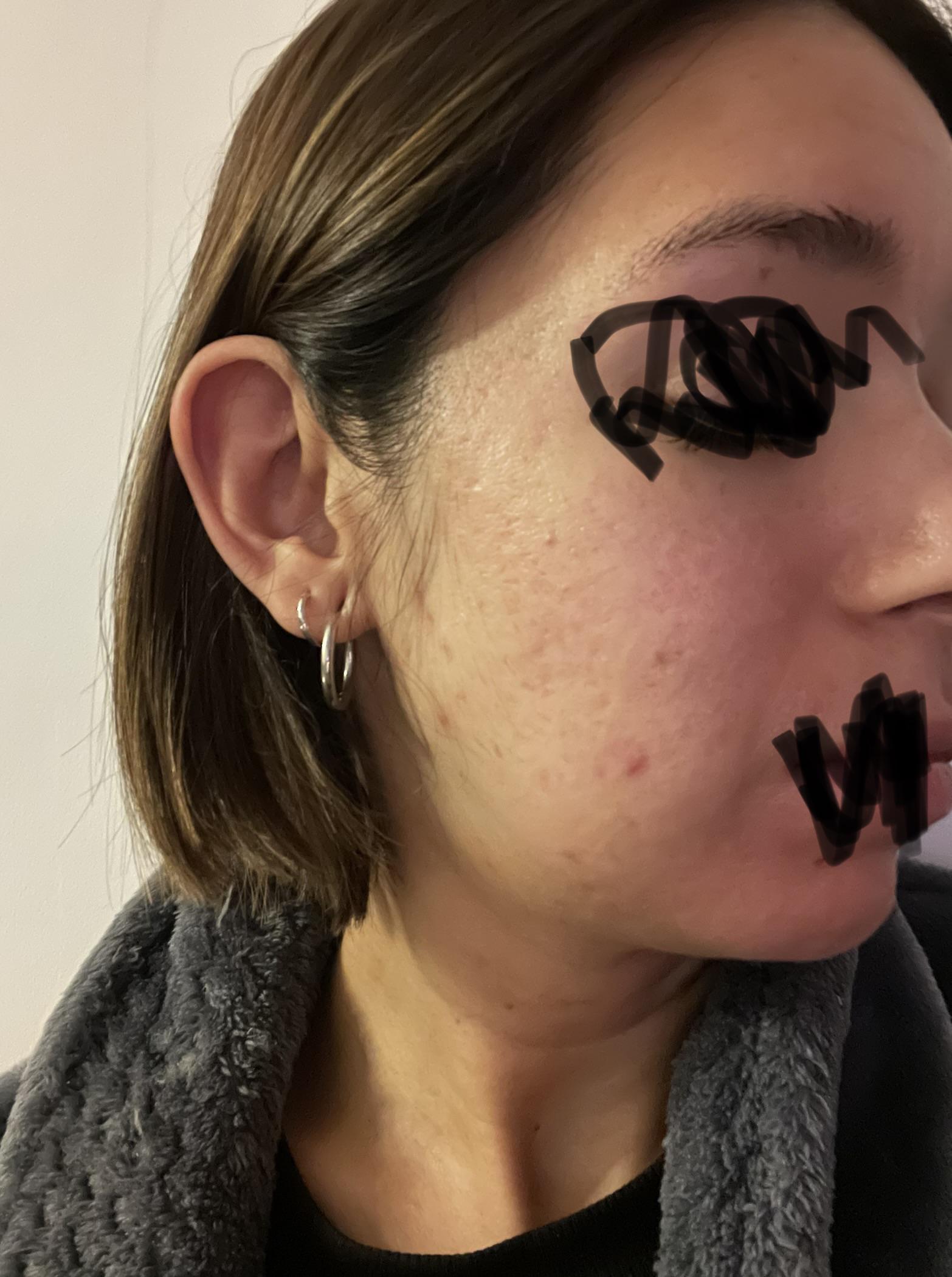 Help needed, what kind of scarring is this? Best course of scar