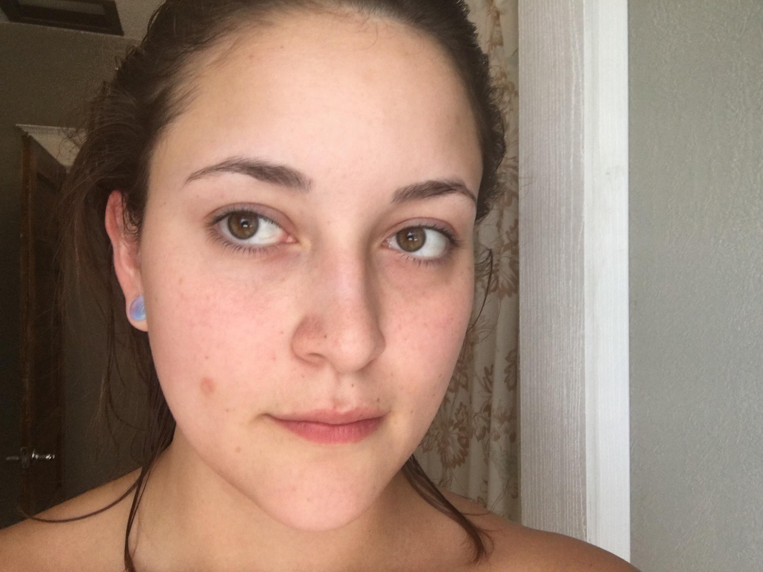 [Skin Concern] Does anyone know how I can fade the scar left on my face