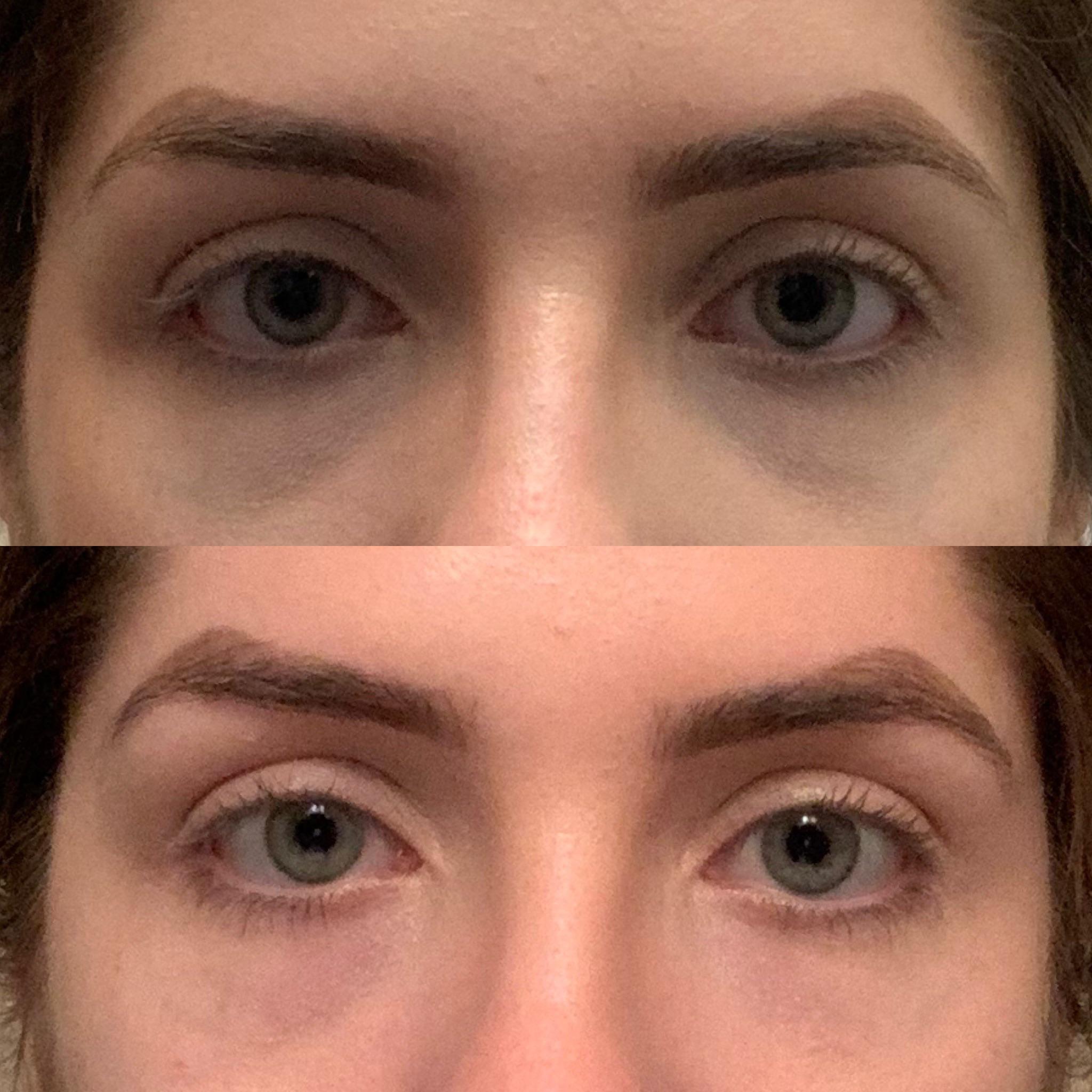Before and immediately after tear trough fillers r/PlasticSurgery