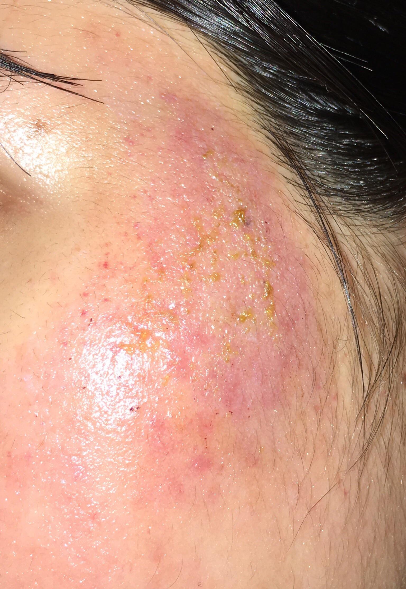 [skin concern] I got microneedling and a chemical peel yesterday... not