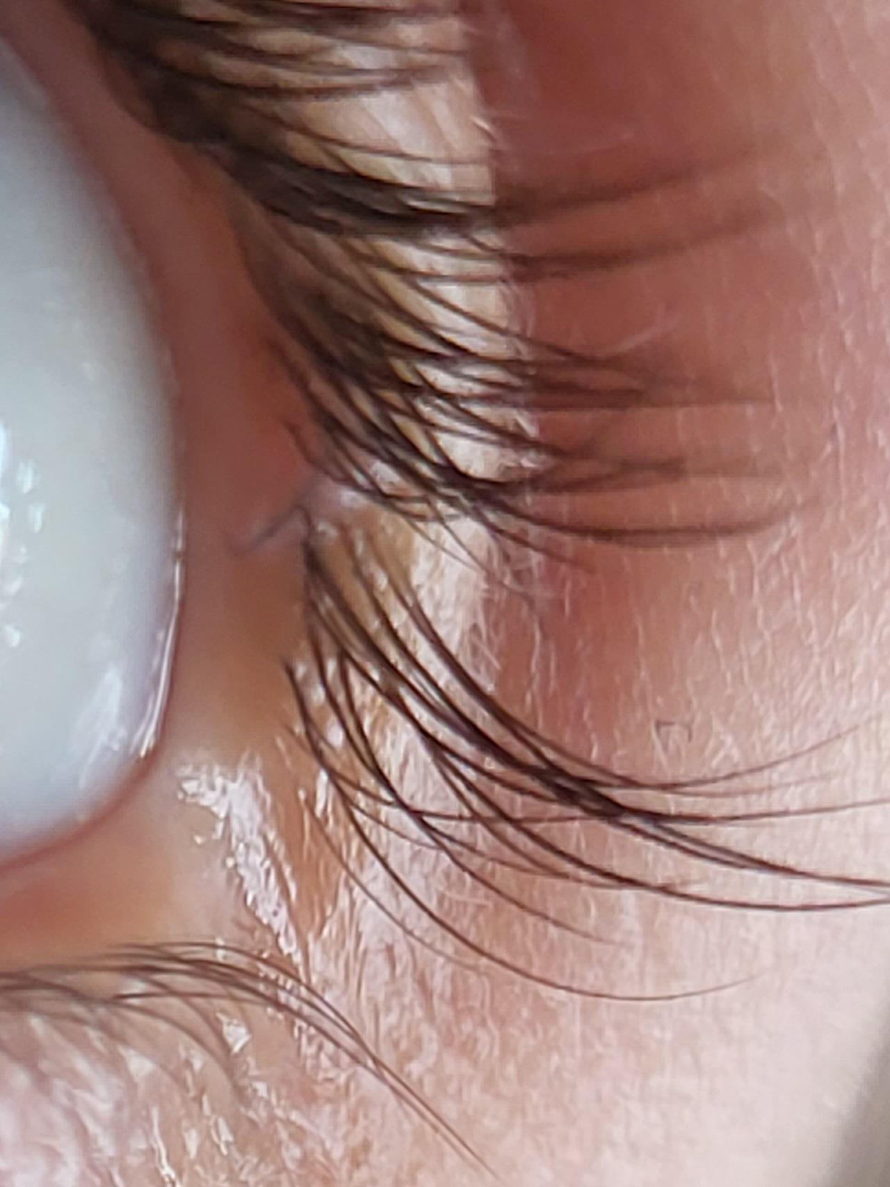 remove ingrown eyelash r/howto