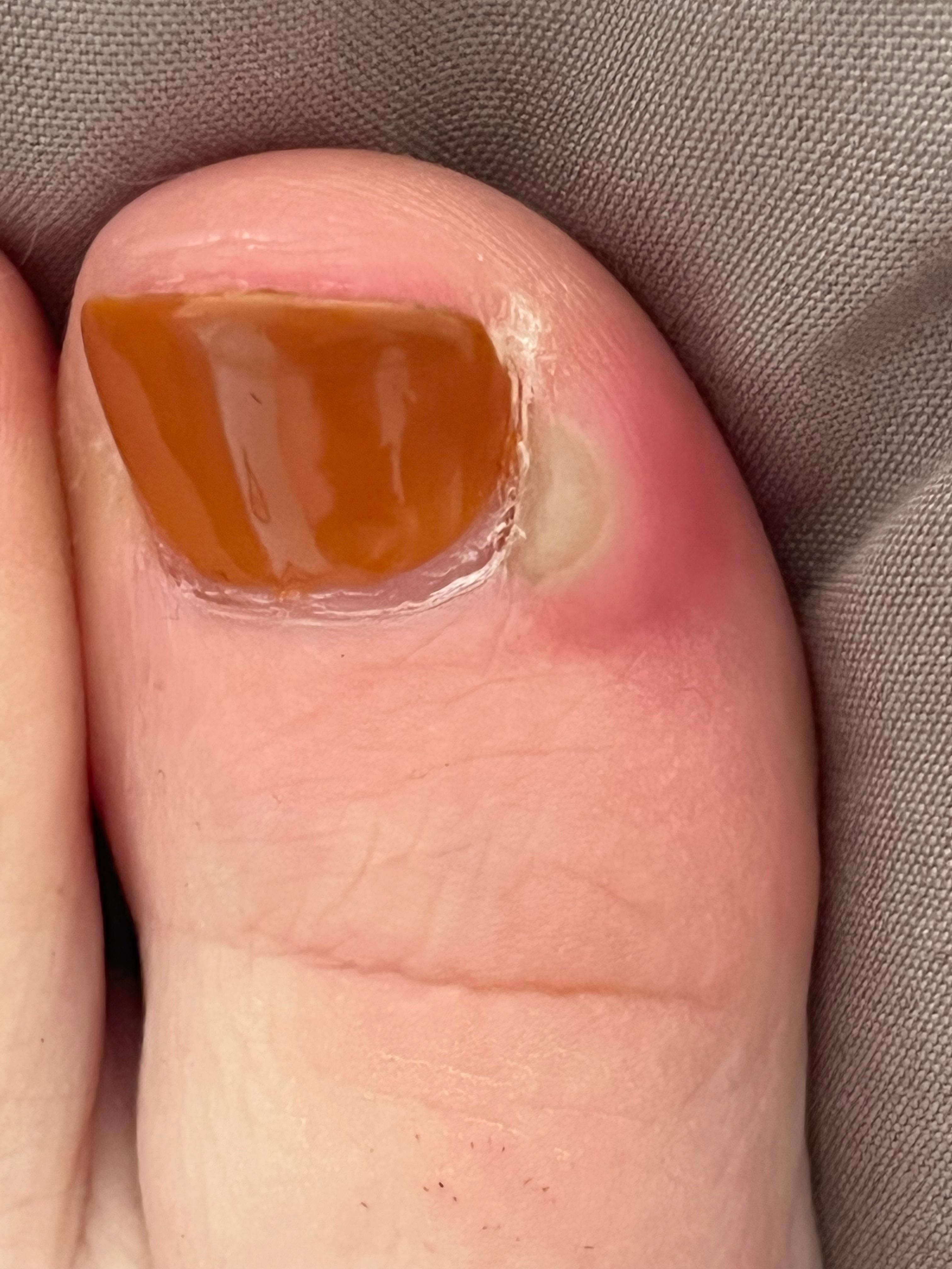 Infected Toenail From Pedicure