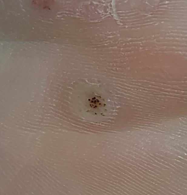 Albums 102+ Pictures Images Of A Wart Sharp