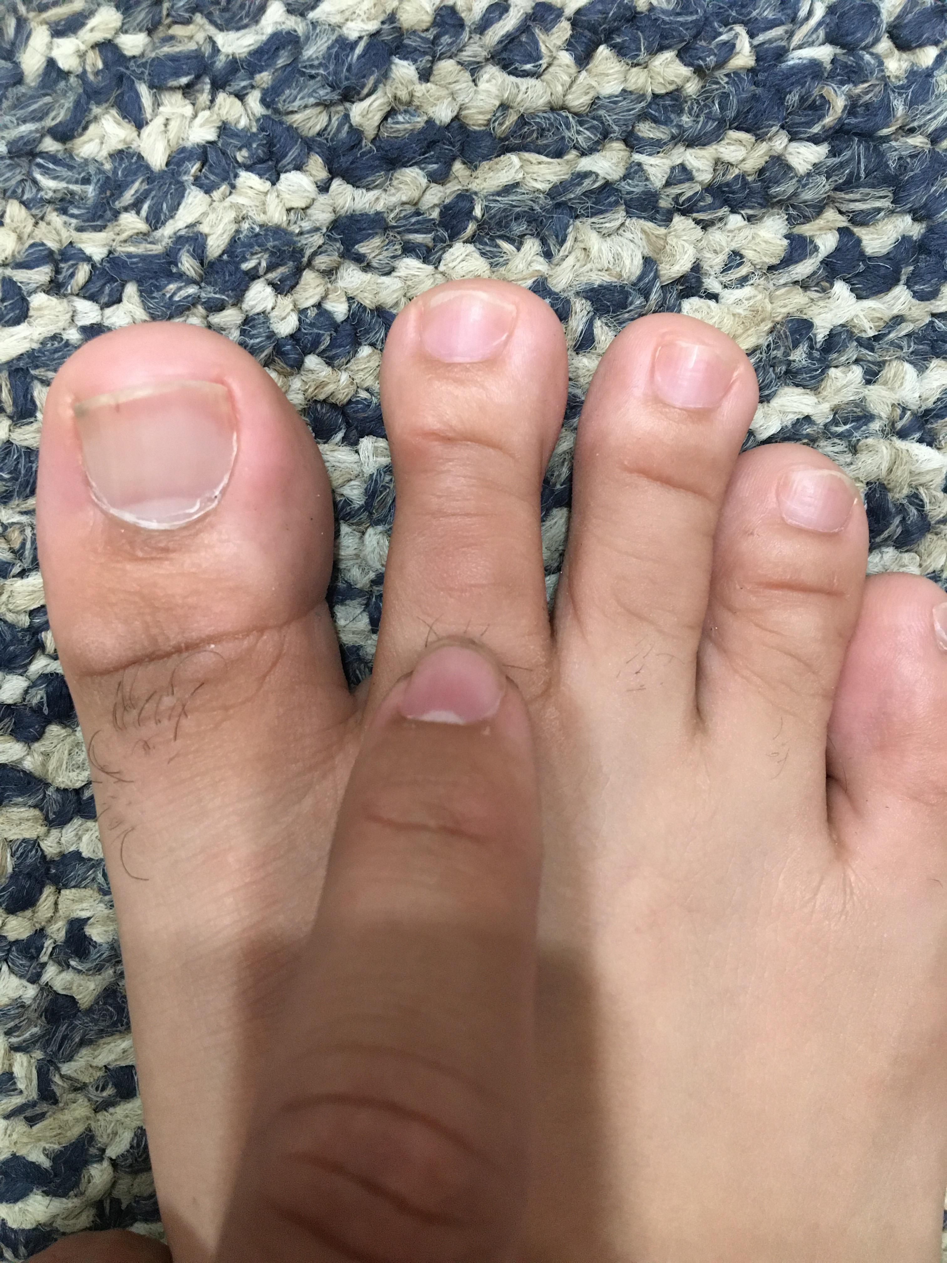 Been running again and my 2nd toe joint hurts r/BarefootRunning