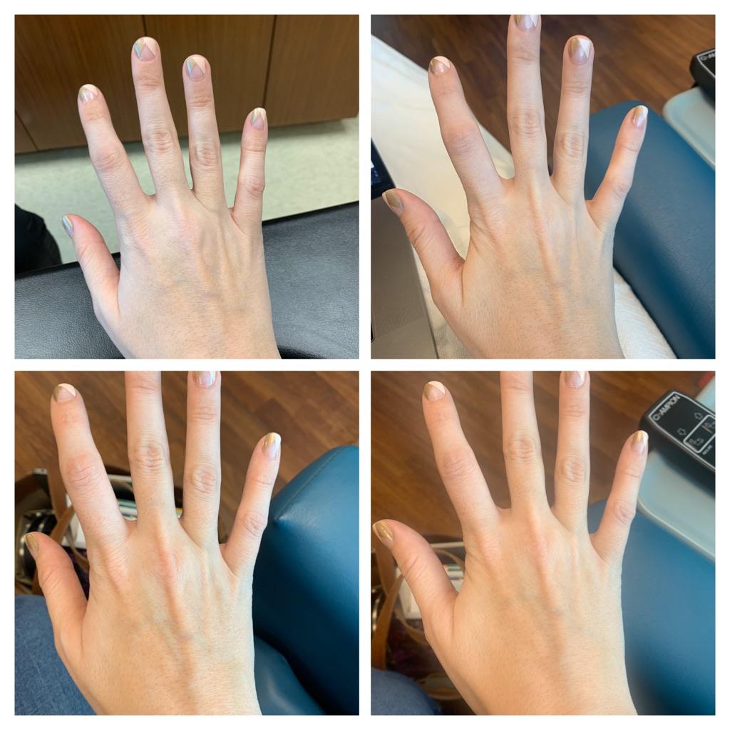 My skin before, during, and after an iron infusion. (6 hours between