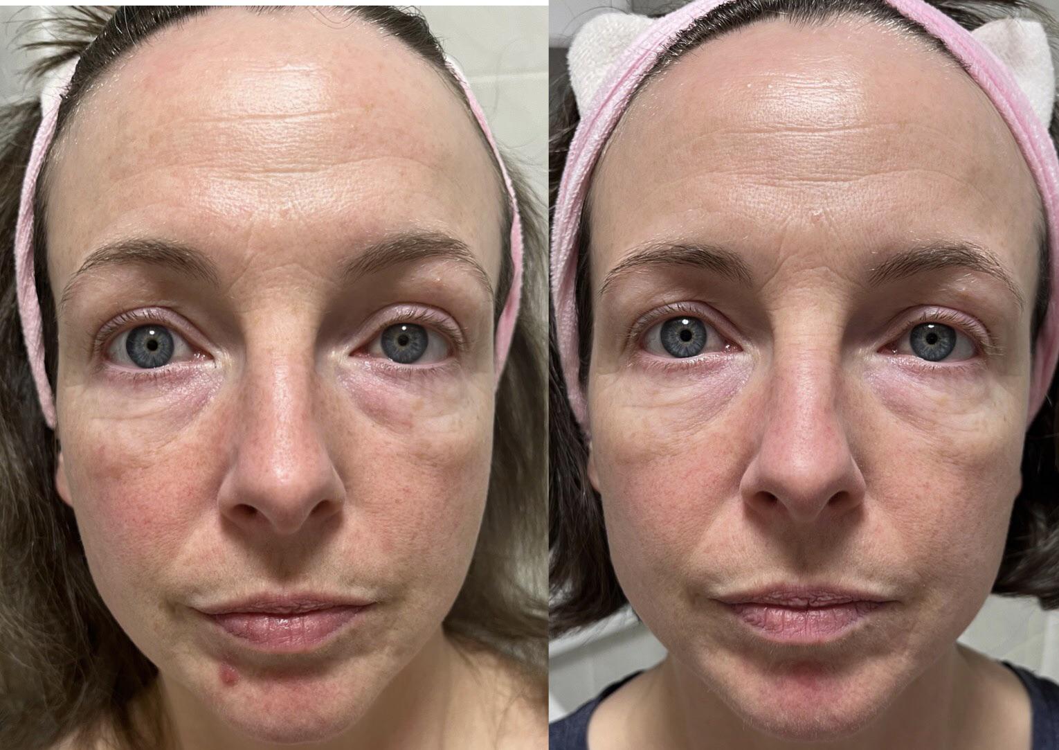 [Before and After] Azelaic acid and Niacinamide progress. One month. r/SkincareAddiction