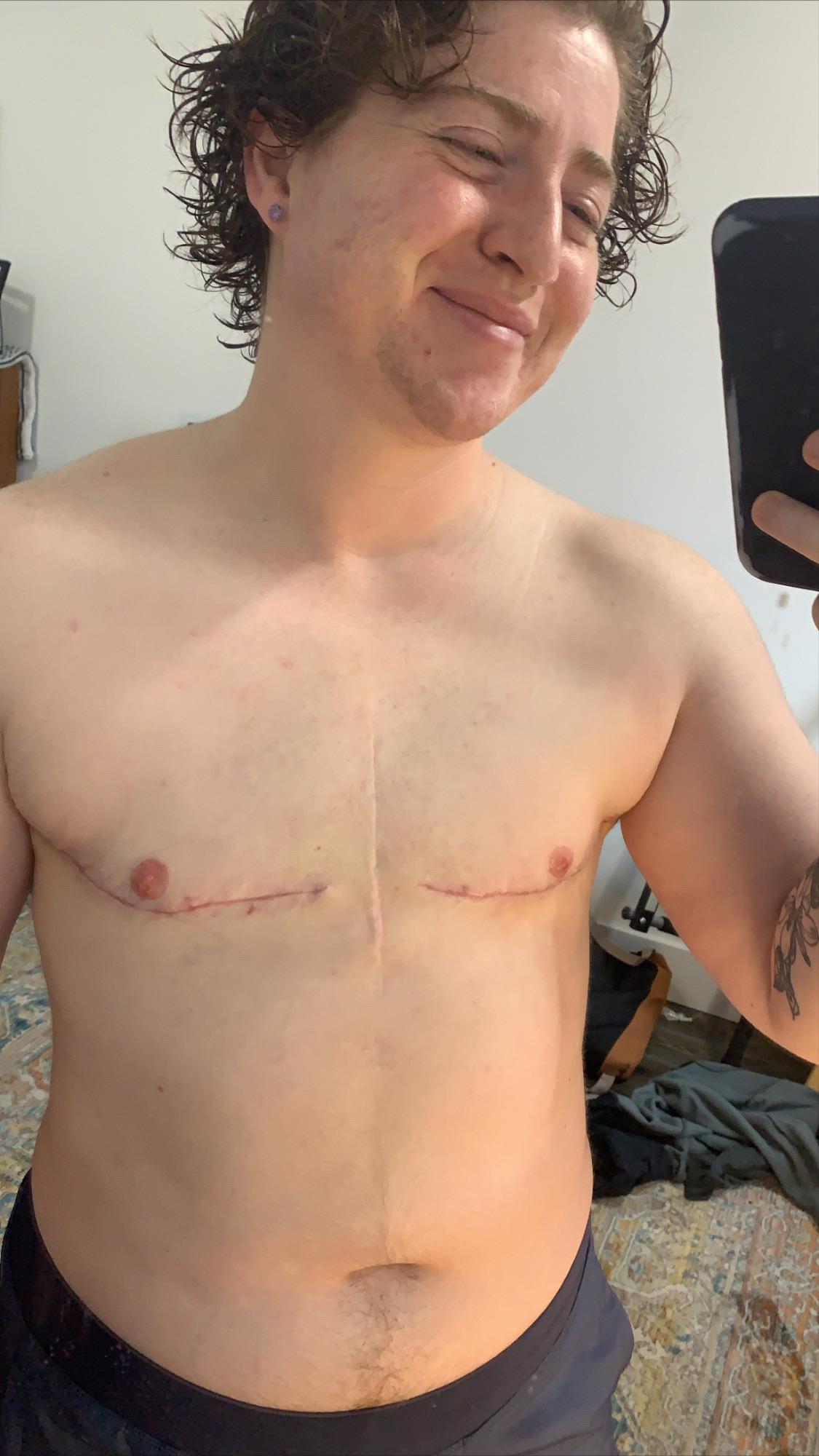 DESIGNER BOD 2 months postop, back to 100, doing push ups and all. So