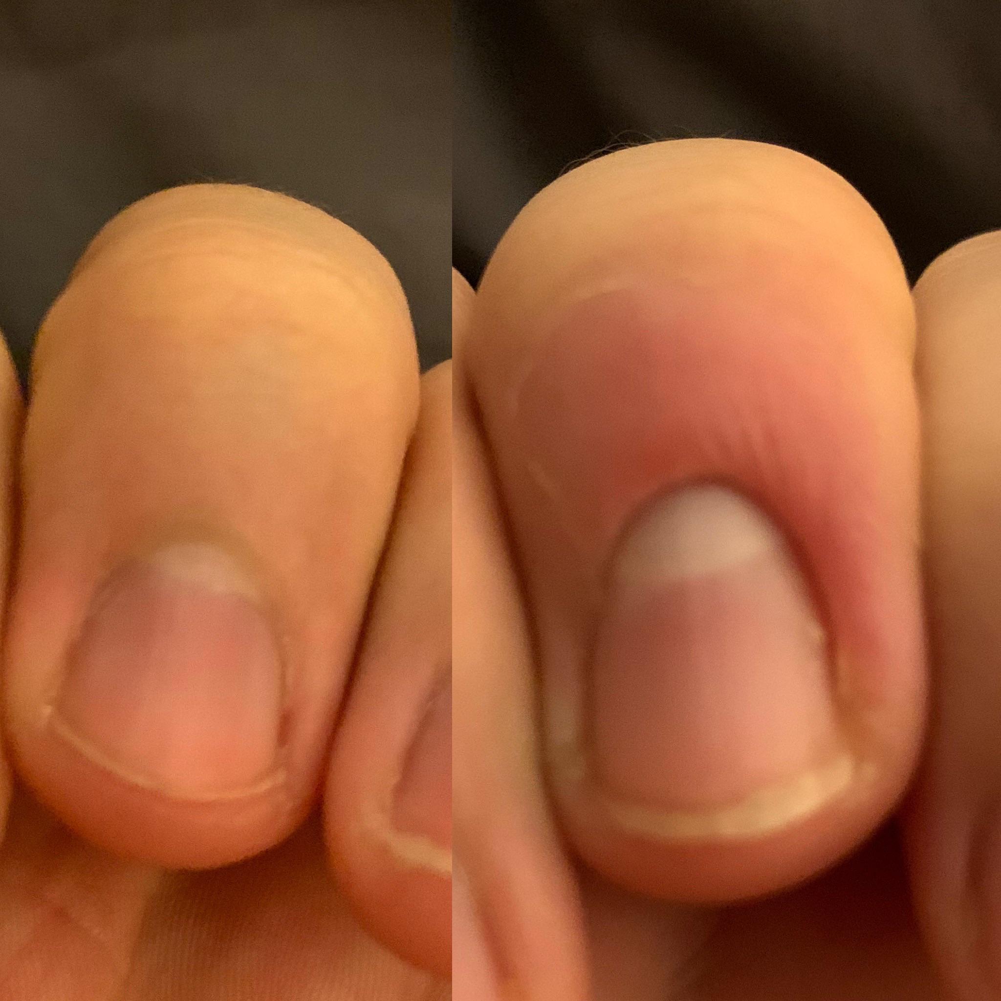 Nail bed has receded after recovering from paronychia… will it grow