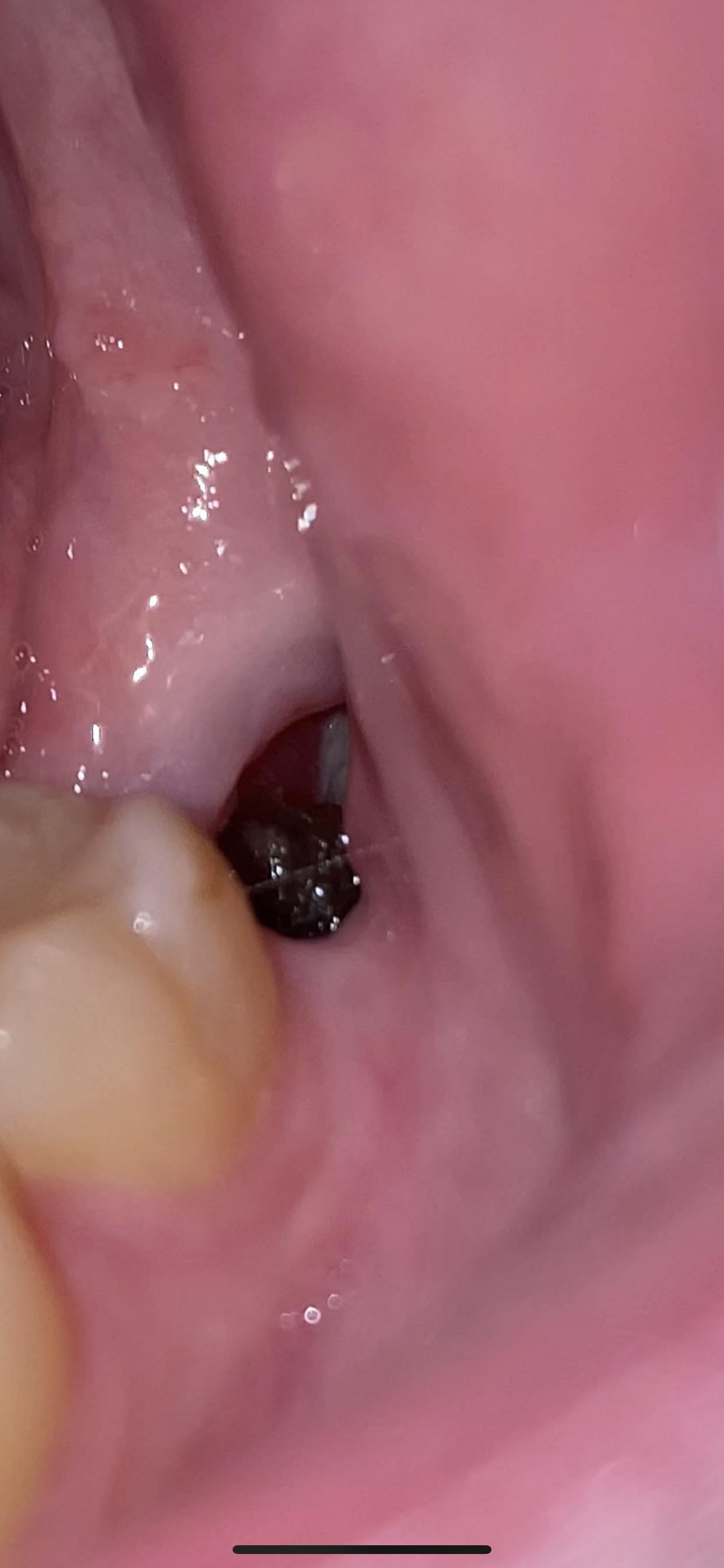 Healthy Wisdom Tooth Extraction Site