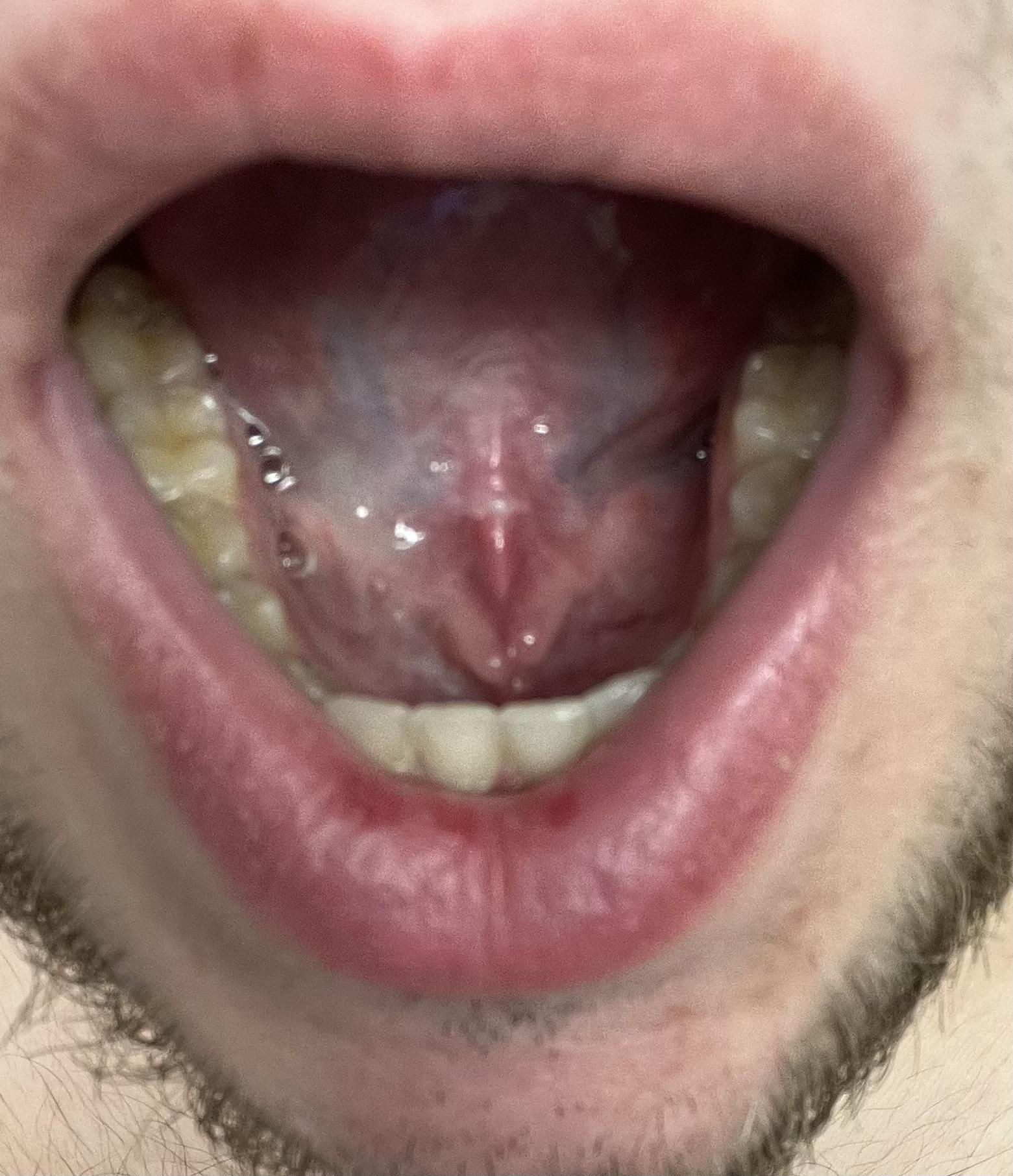 What are these bumps under my tongue? r/medical_advice