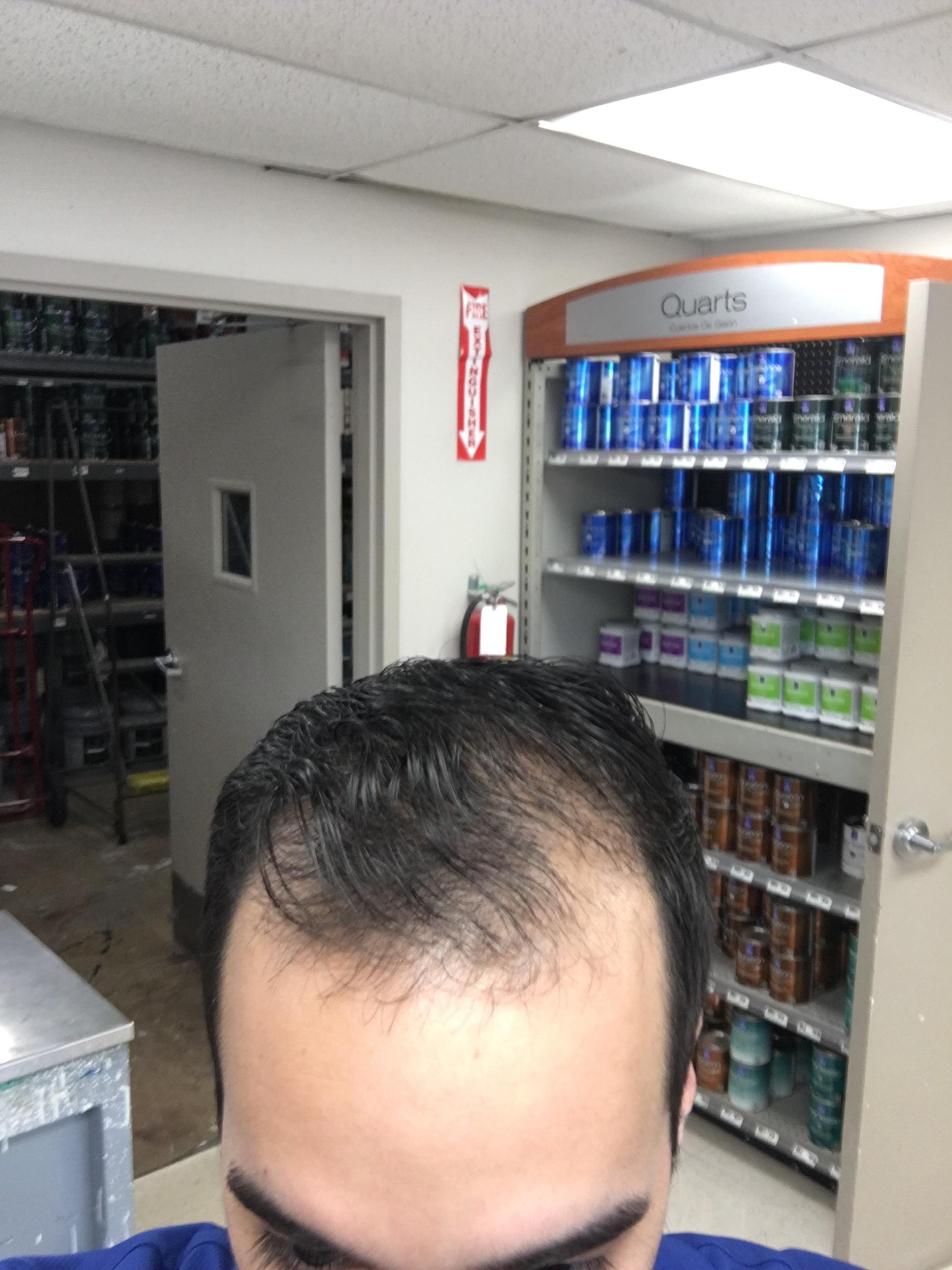 Balding no matter what I do or product I try. Is it time for the buzz