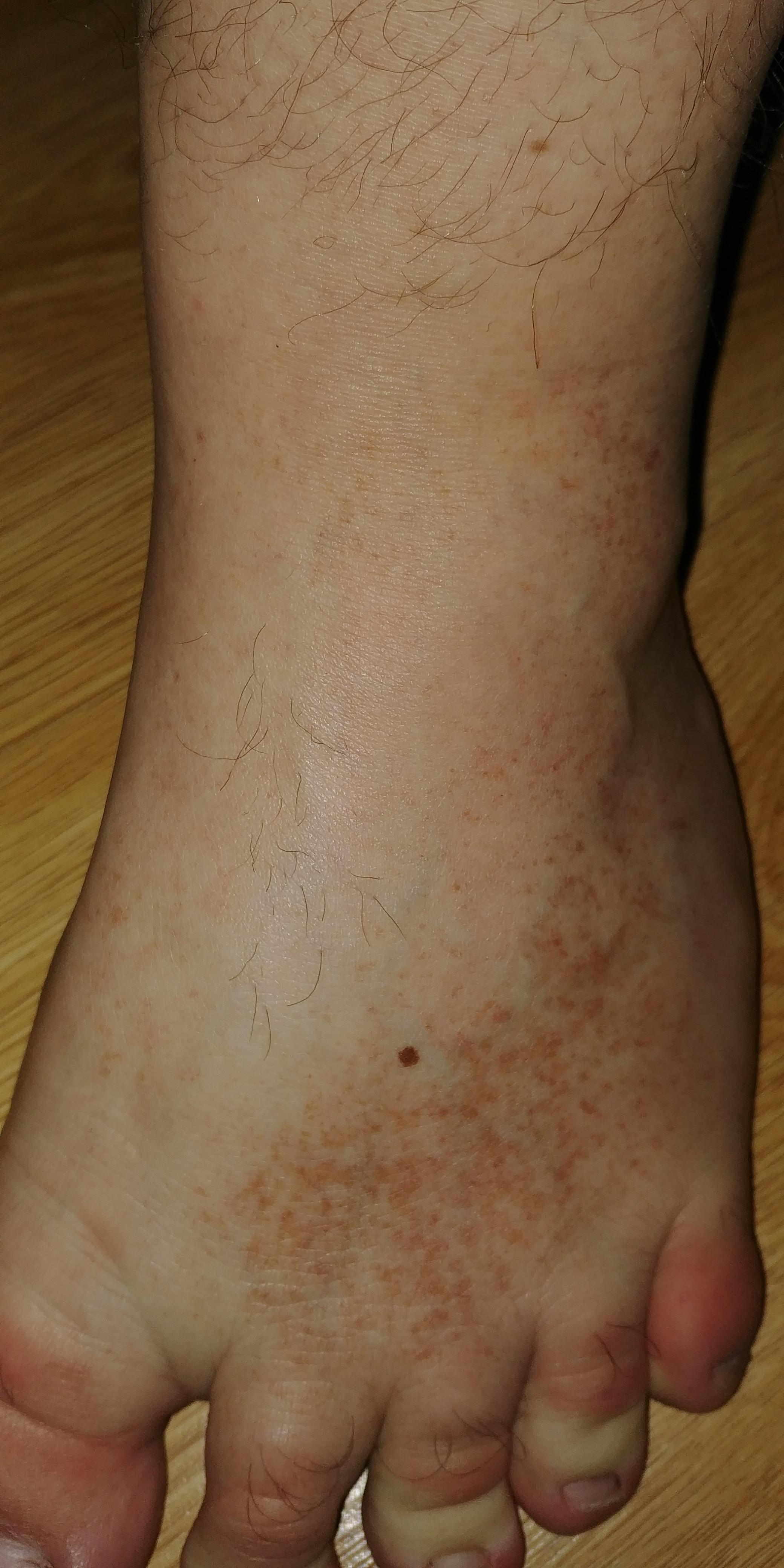 whats the brown spots on my foot its been growing over both my feet