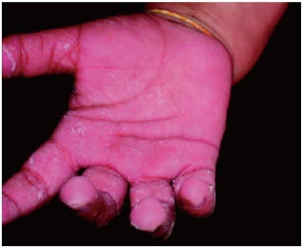 dermatology What is the reason for pink discoloration in pink disease