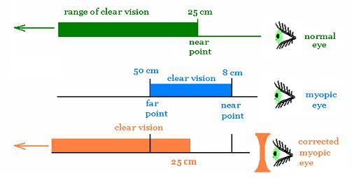 human biology Near point and far point of myopic eye Biology Stack